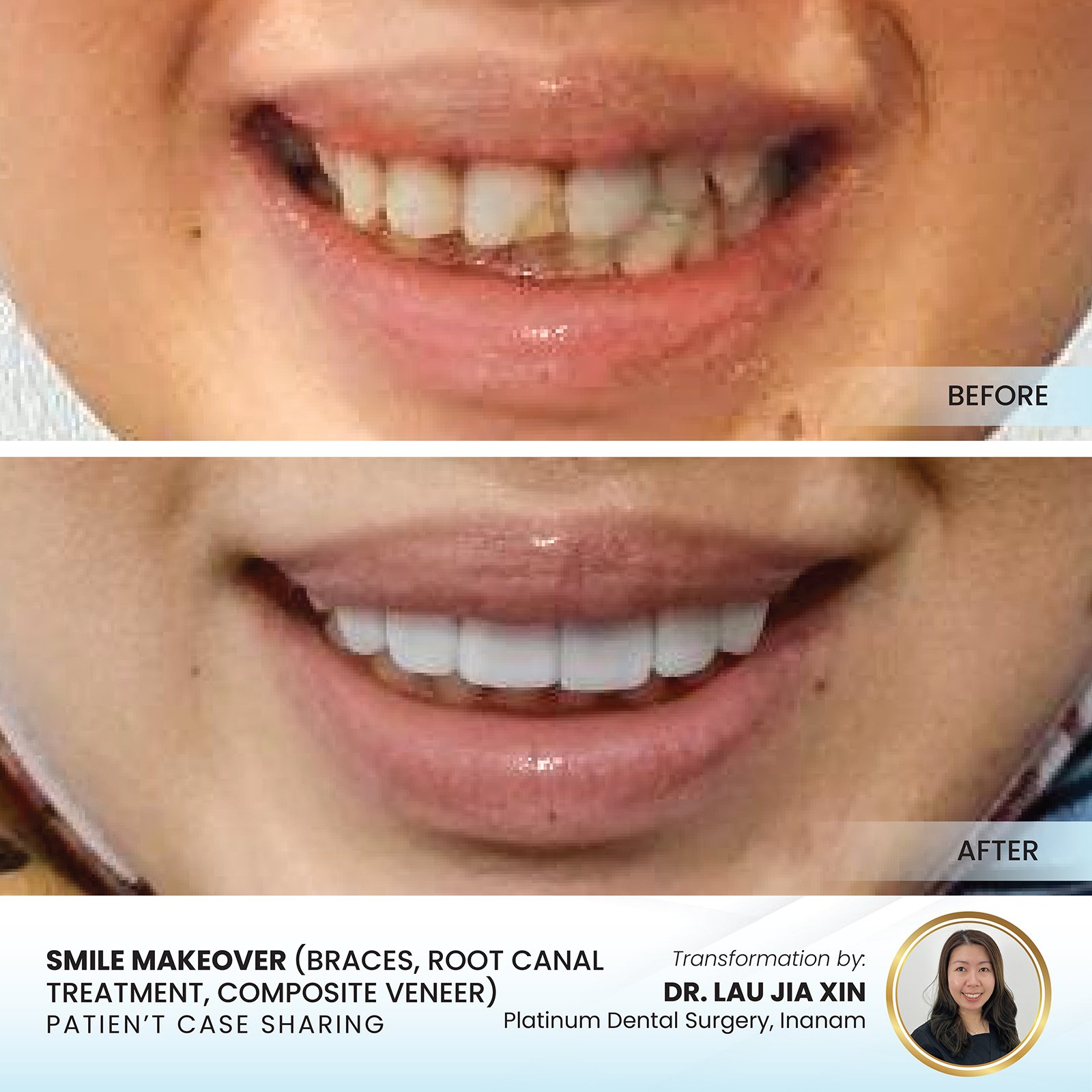 Paediatric dental case result at Platinum Dental Group KK