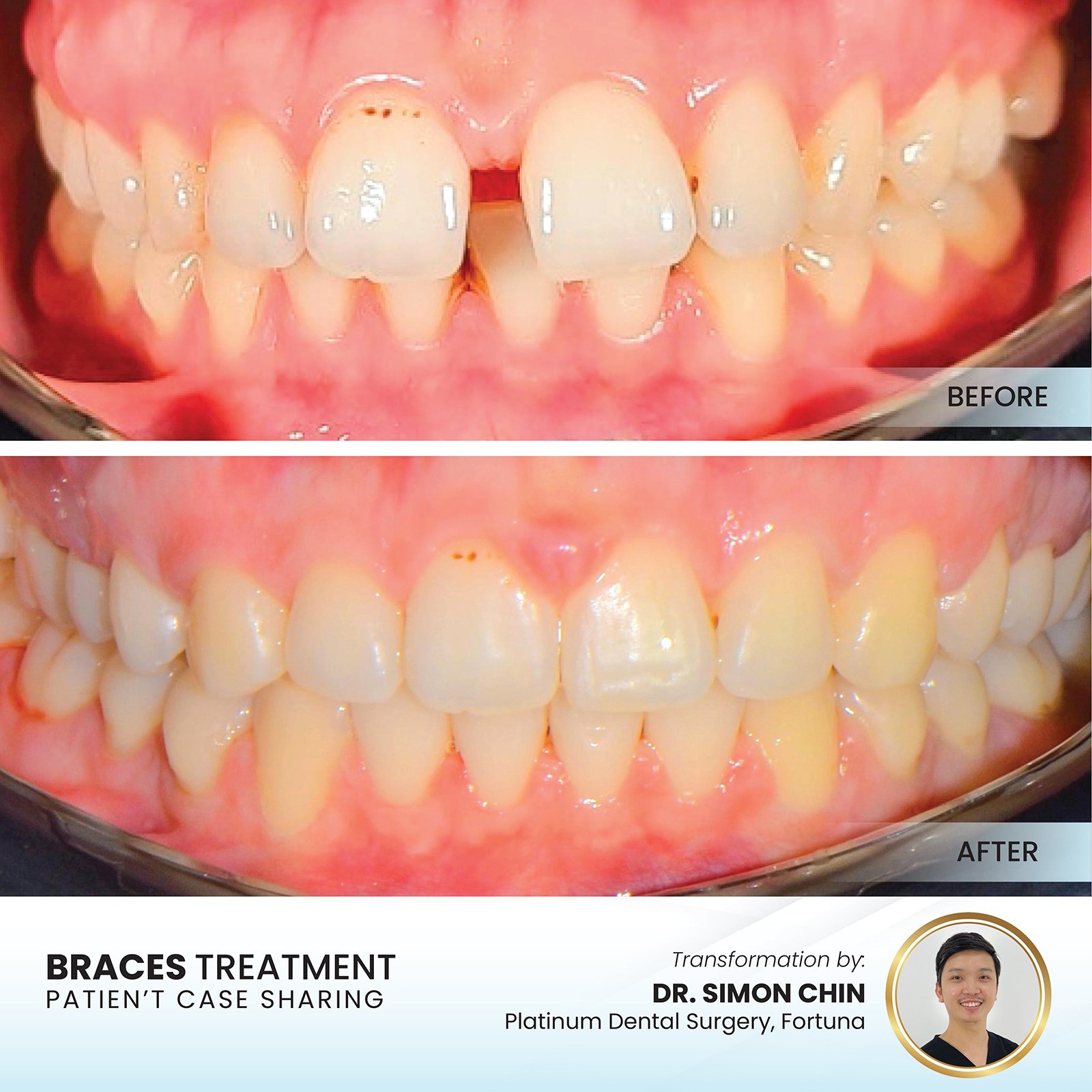 Children dental case result Platinum Dental Group