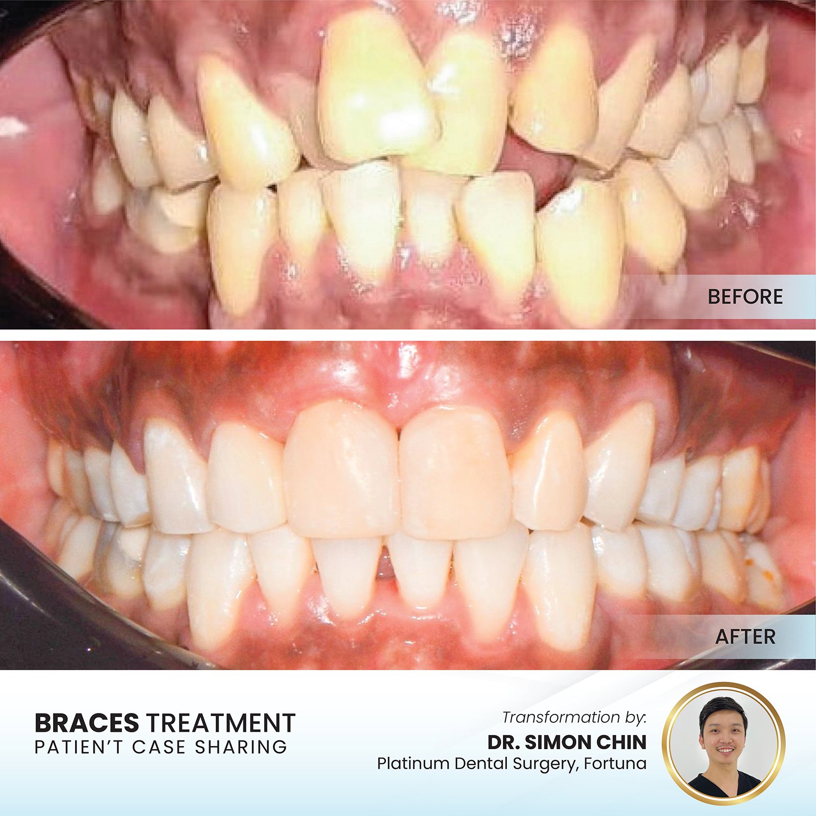 Braces before and after — crowding and protrusion corrected, Platinum Dental Group Kota Kinabalu