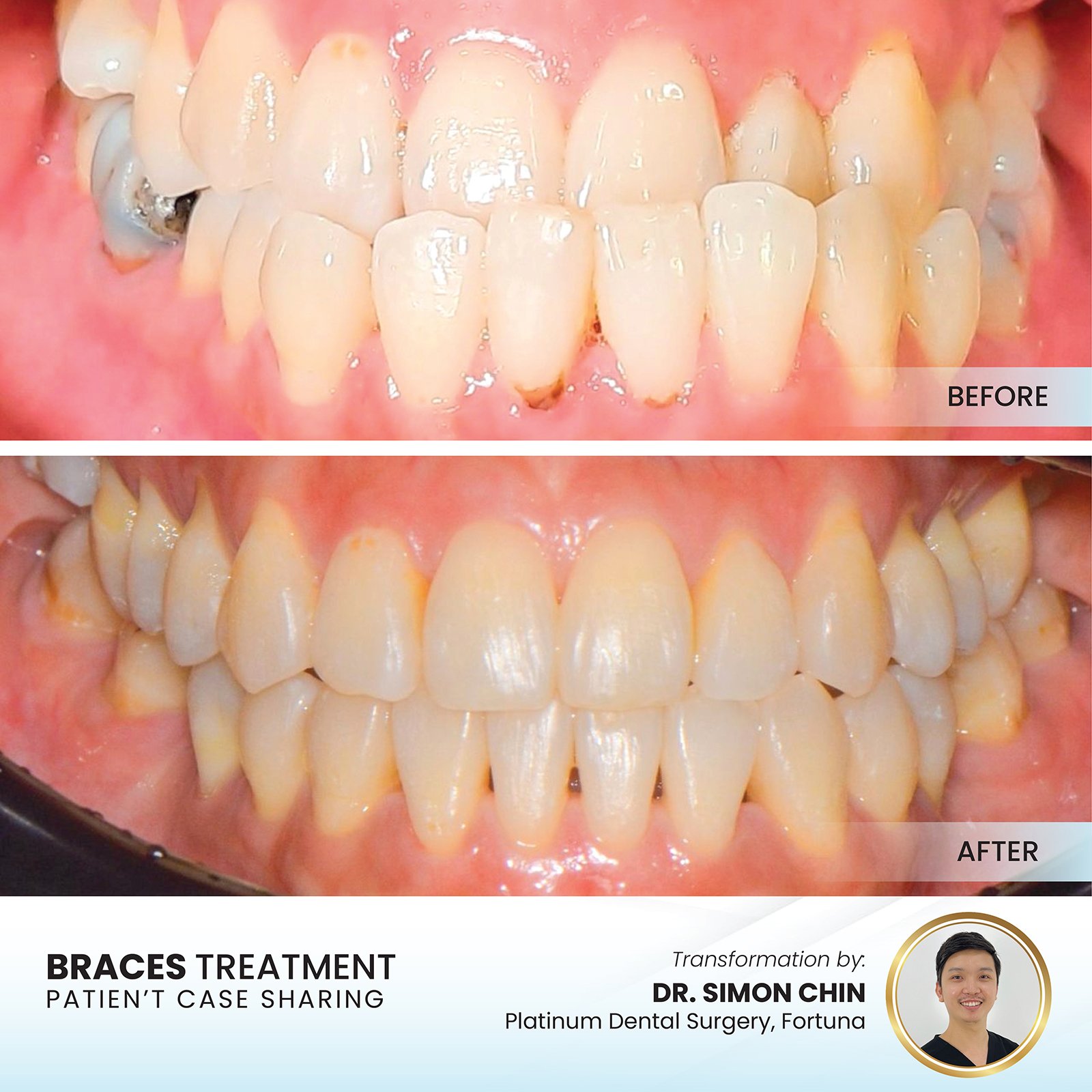 Patient smile transformation - Case I-12