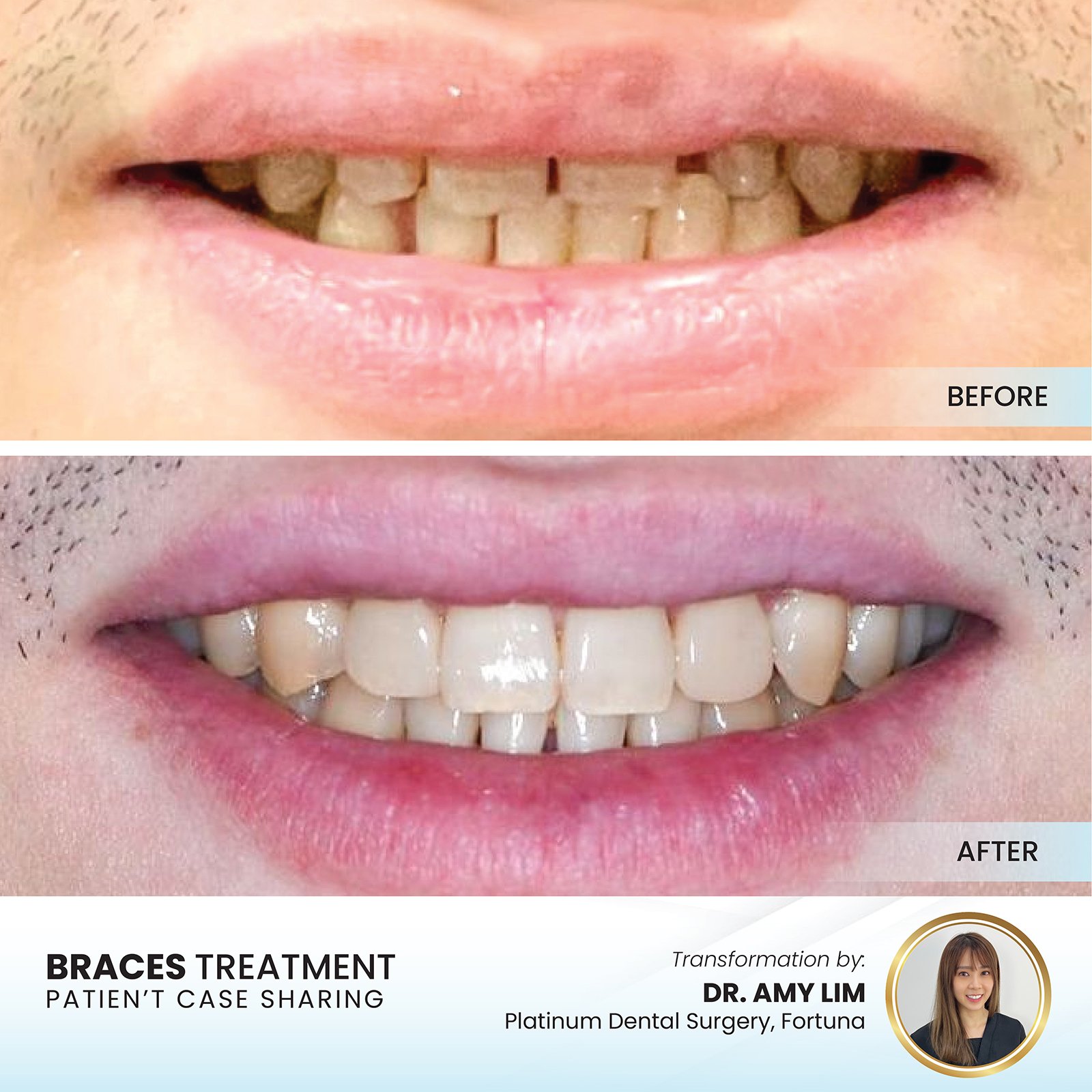 Patient smile transformation - Case I-13