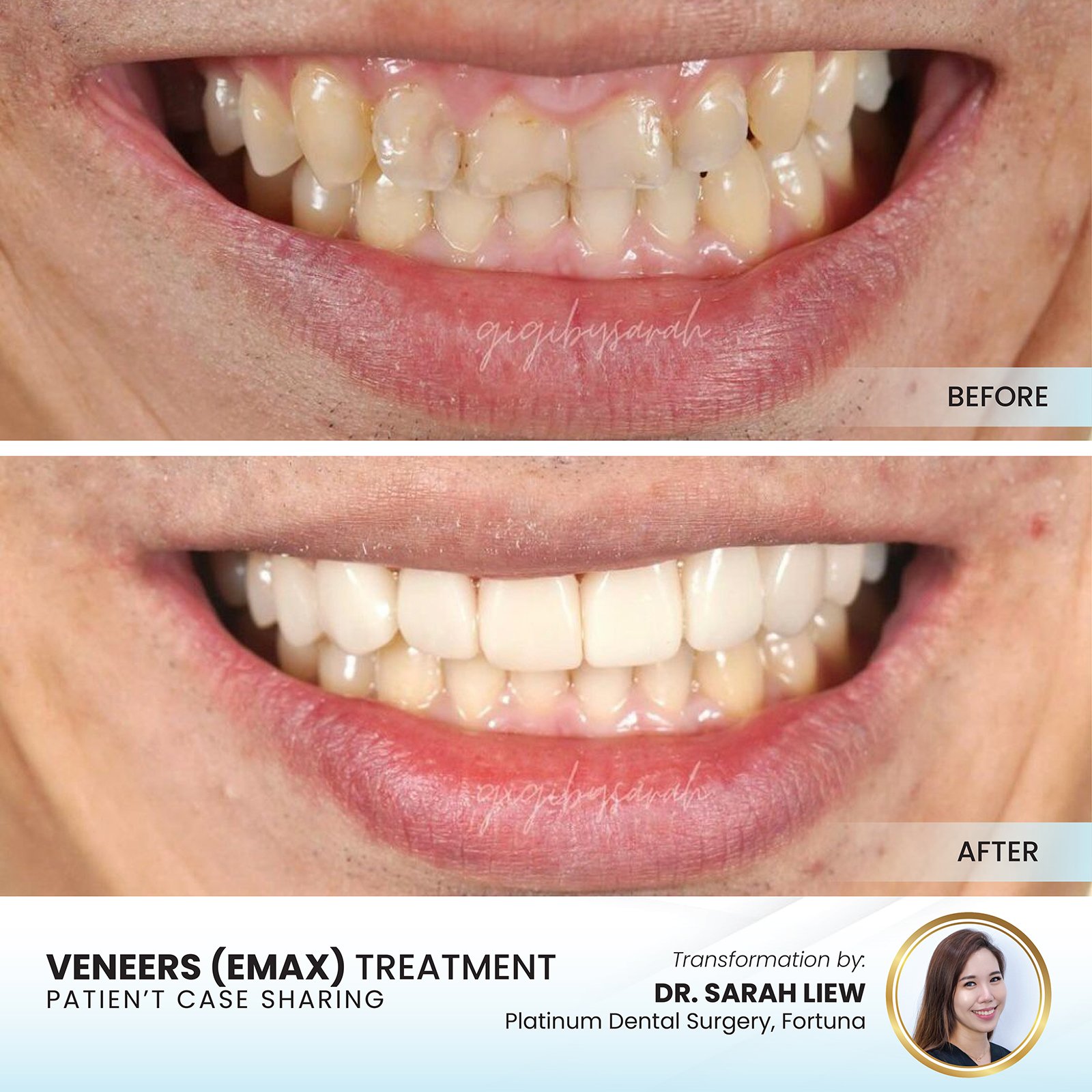 Patient smile transformation - Case I-14