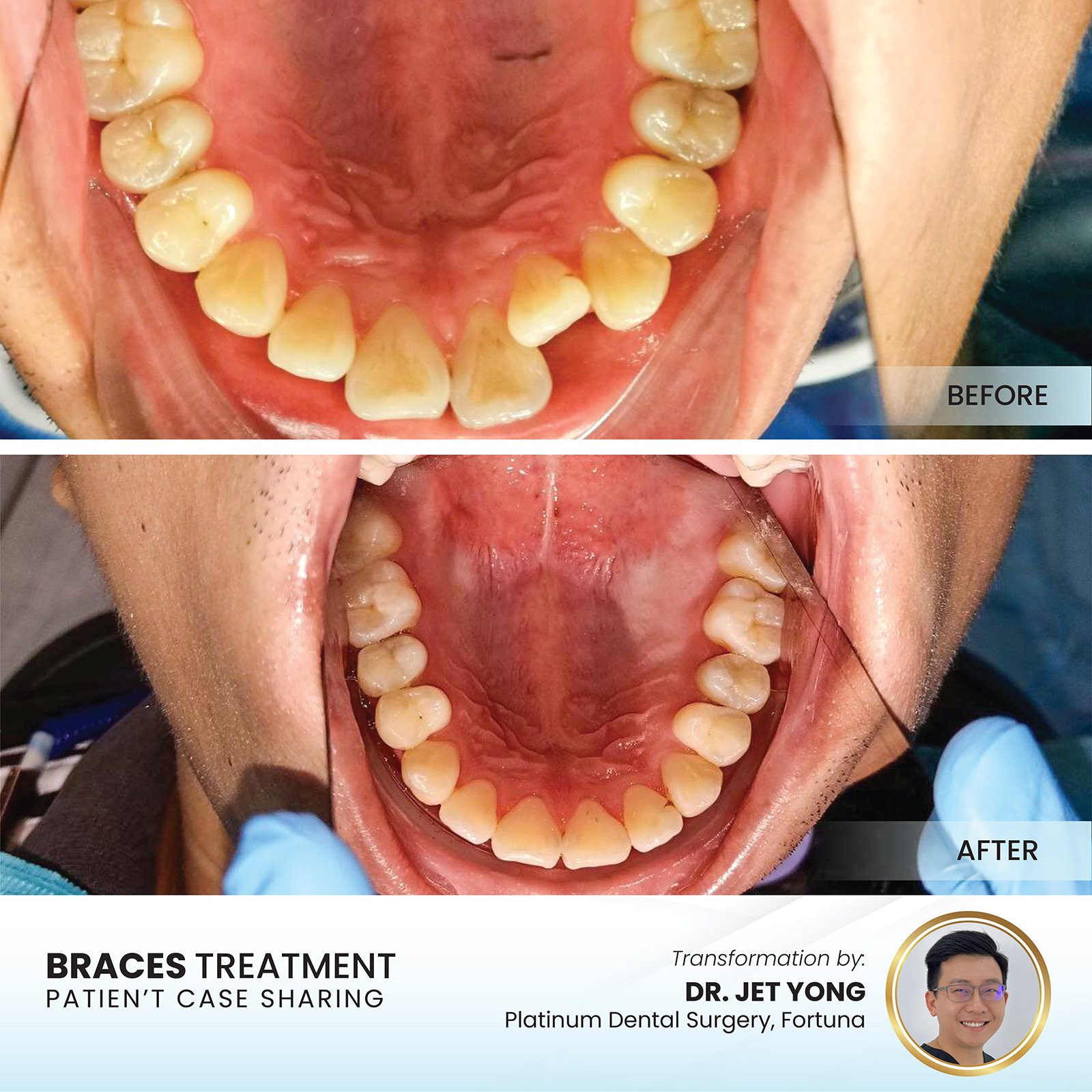 Patient smile transformation - Case I-16