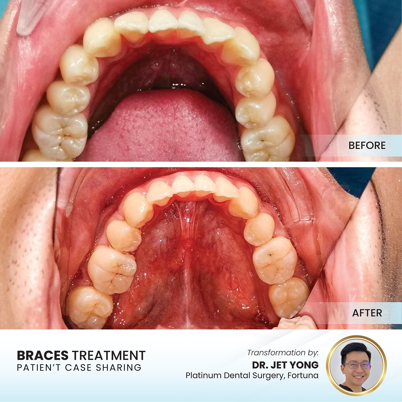 Patient smile transformation - Case I-17