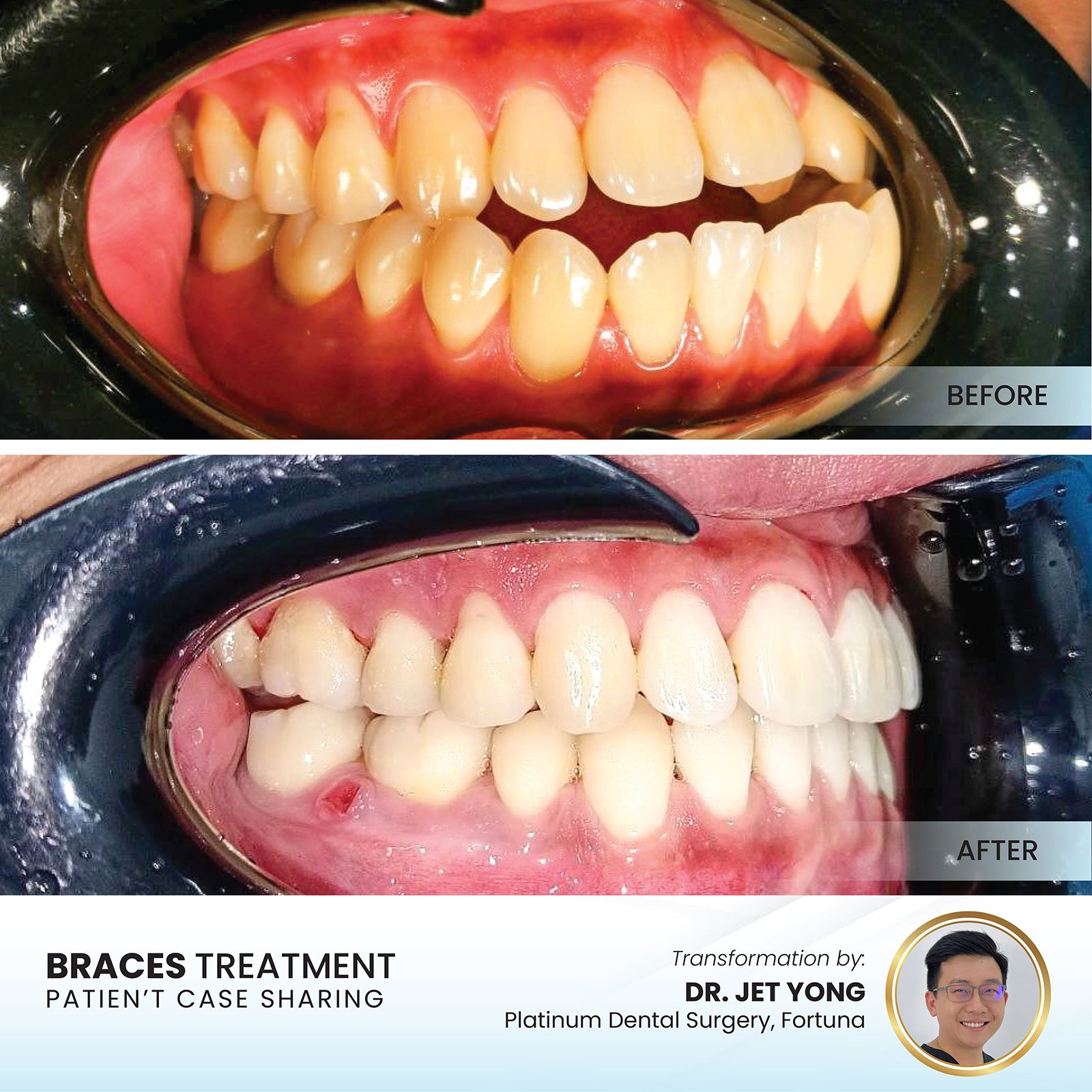 Patient smile transformation - Case I-18