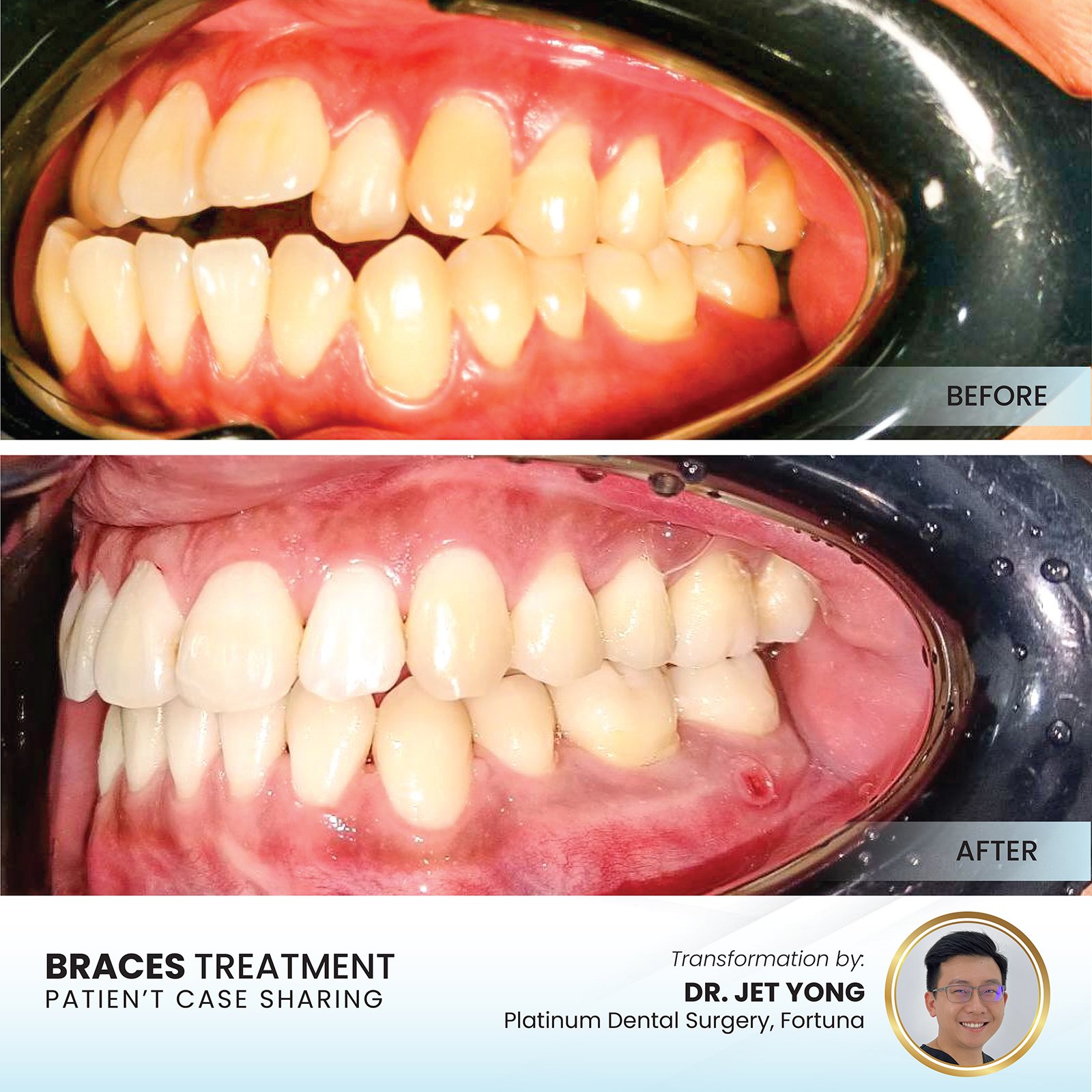 Patient smile transformation - Case I-19