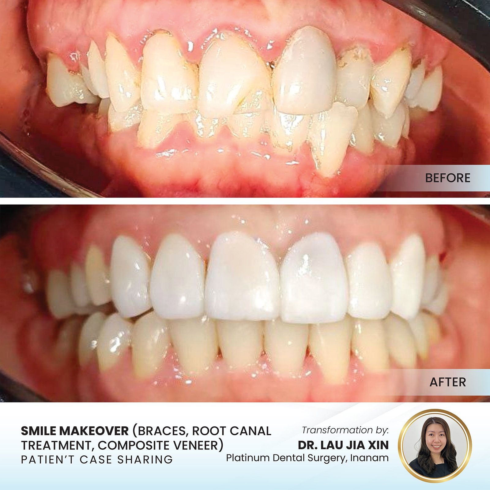 Patient smile transformation - Case I-2