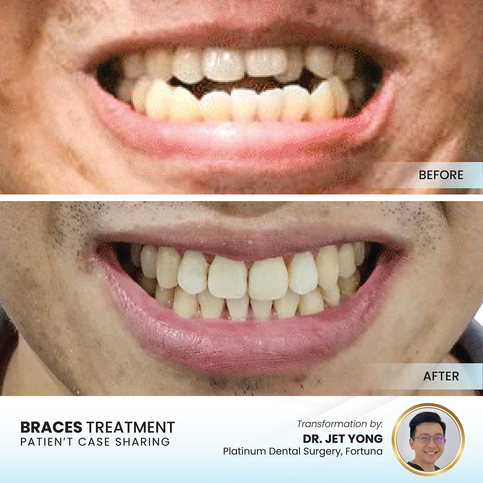 Patient smile transformation - Case I-20