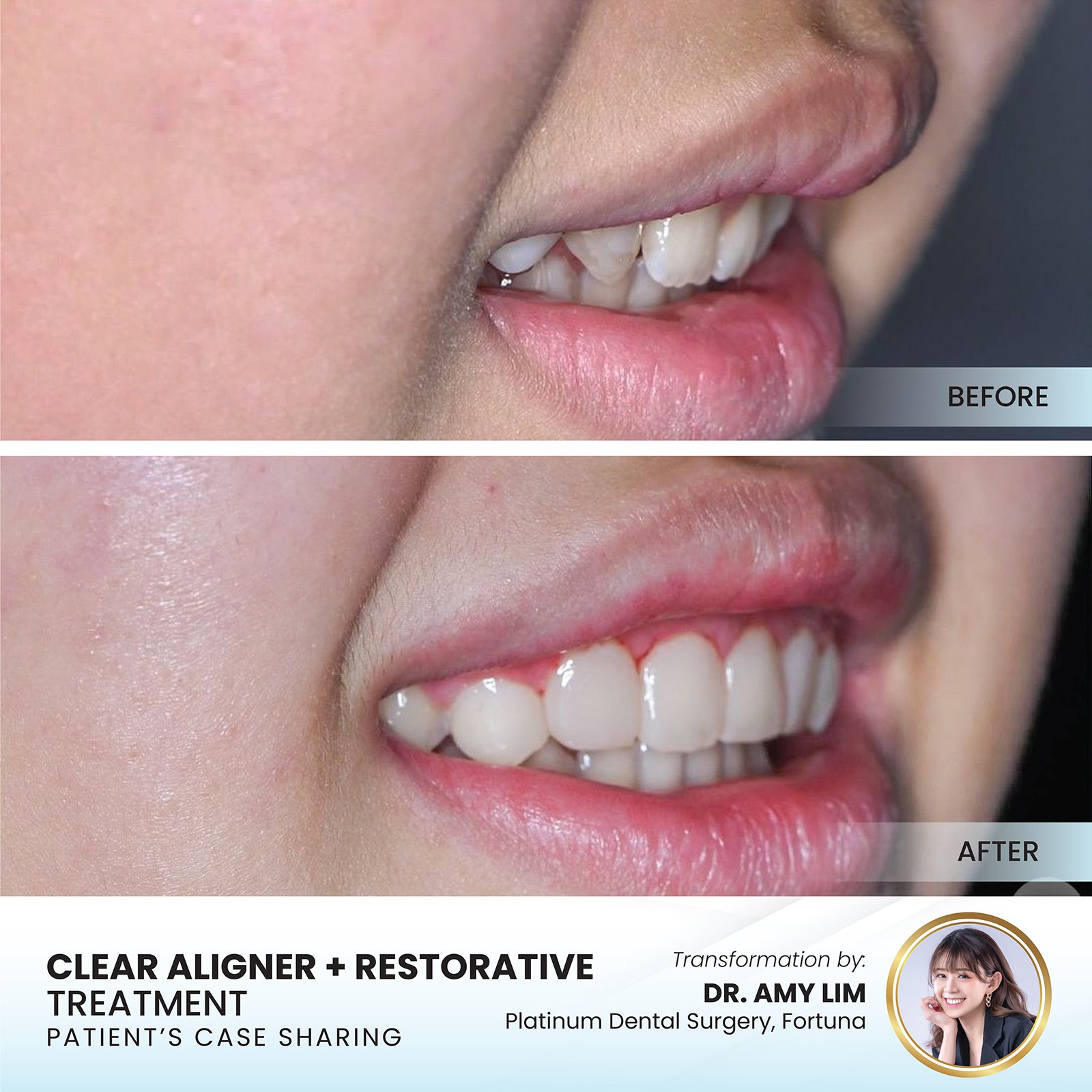 Patient smile transformation - Case I-21