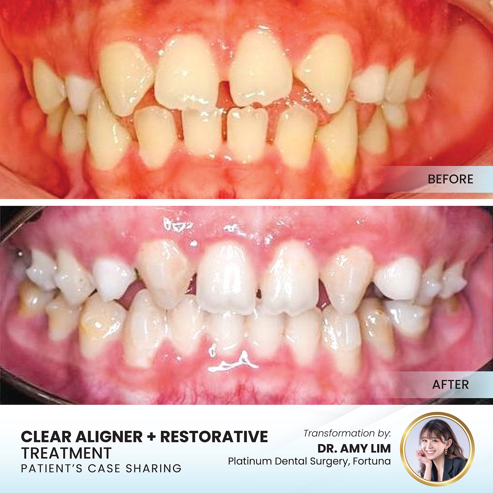 Patient smile transformation - Case I-22