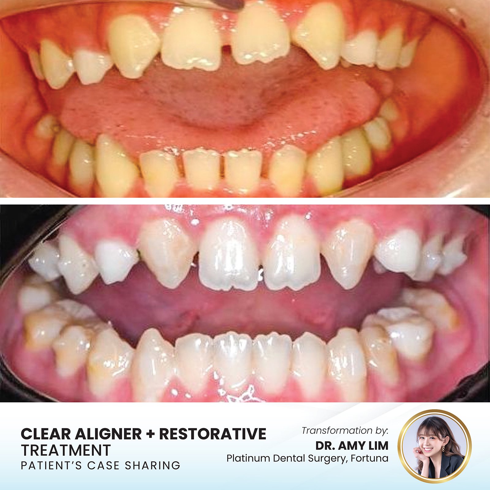 Patient smile transformation - Case I-23