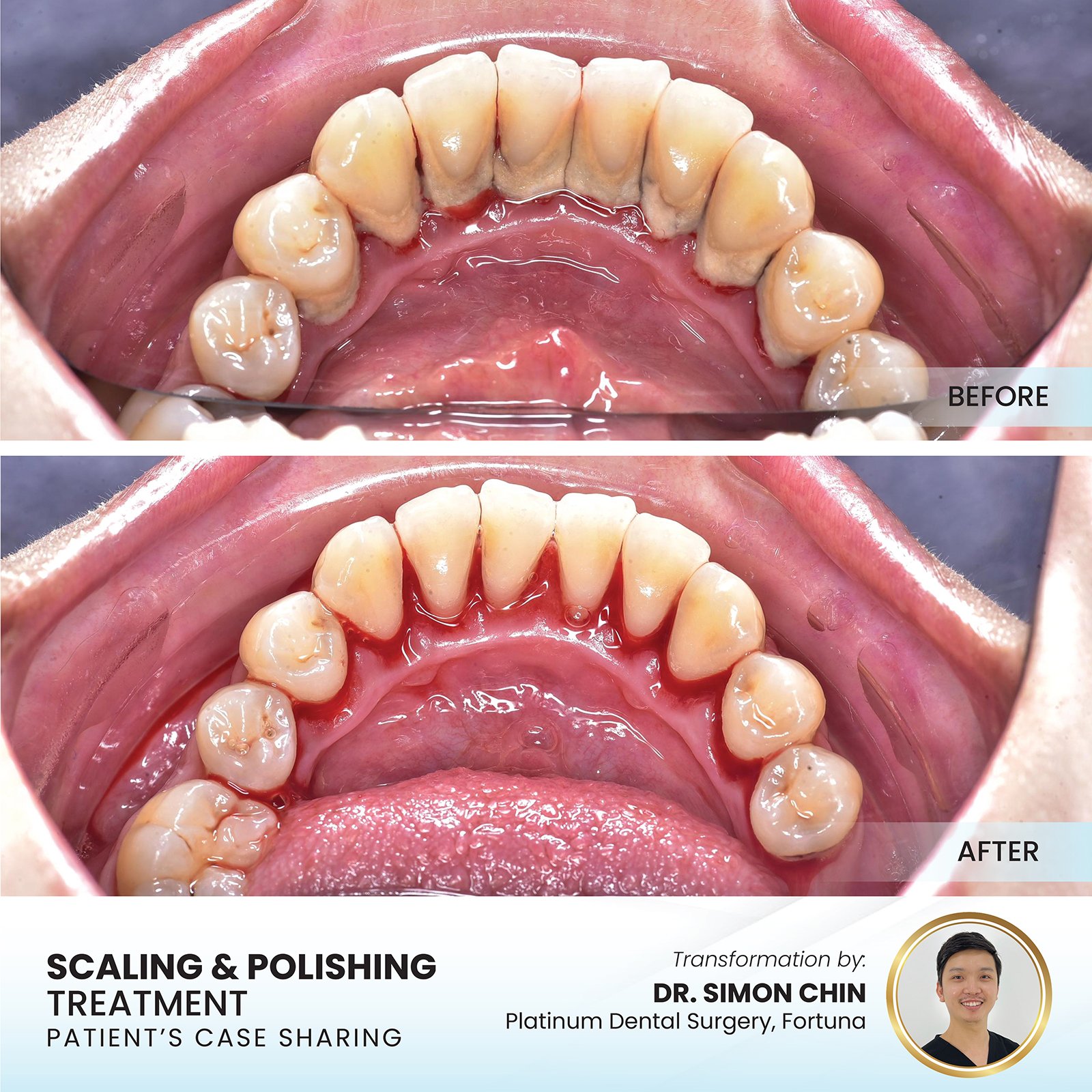 Patient smile transformation - Case I-24
