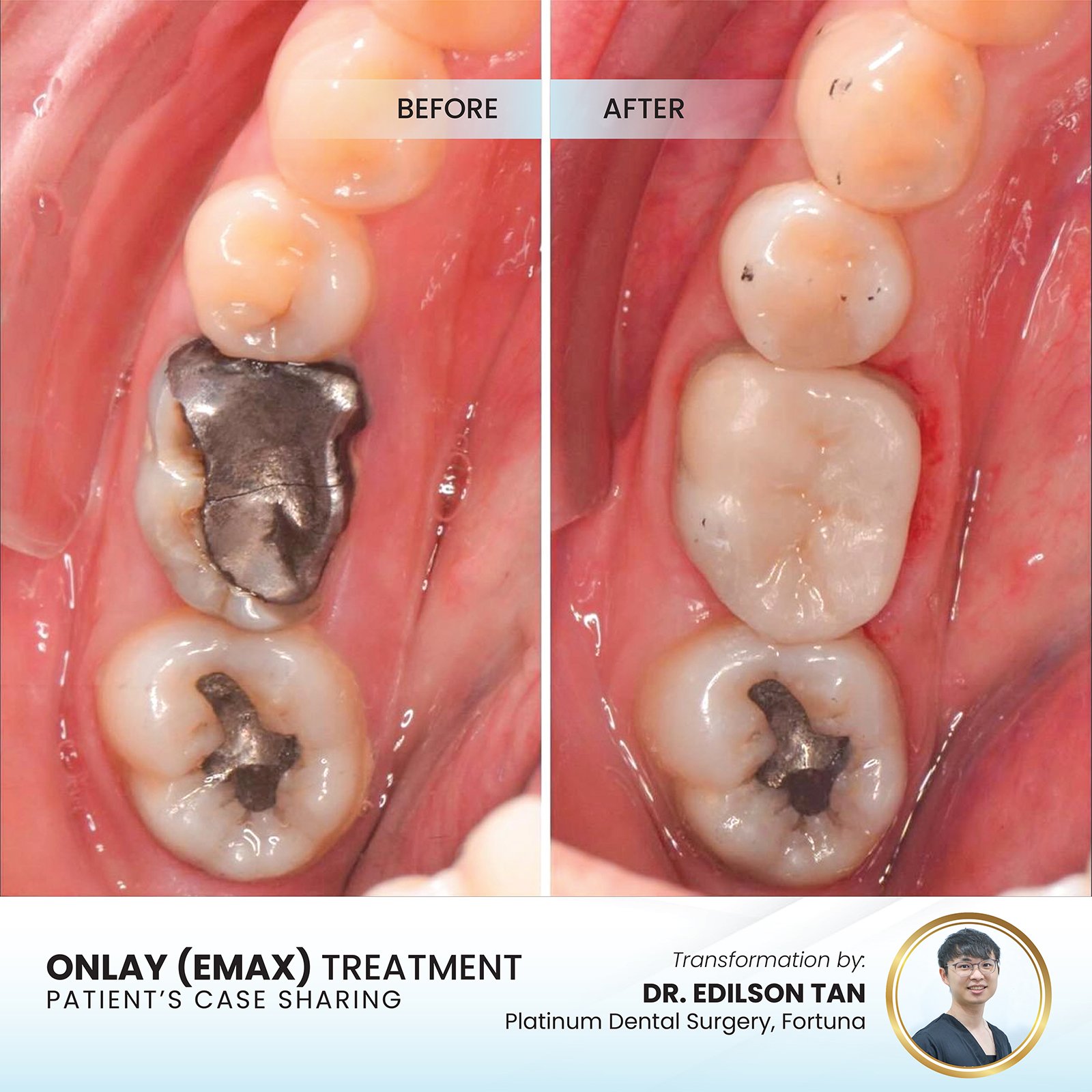 Patient smile transformation - Case I-25