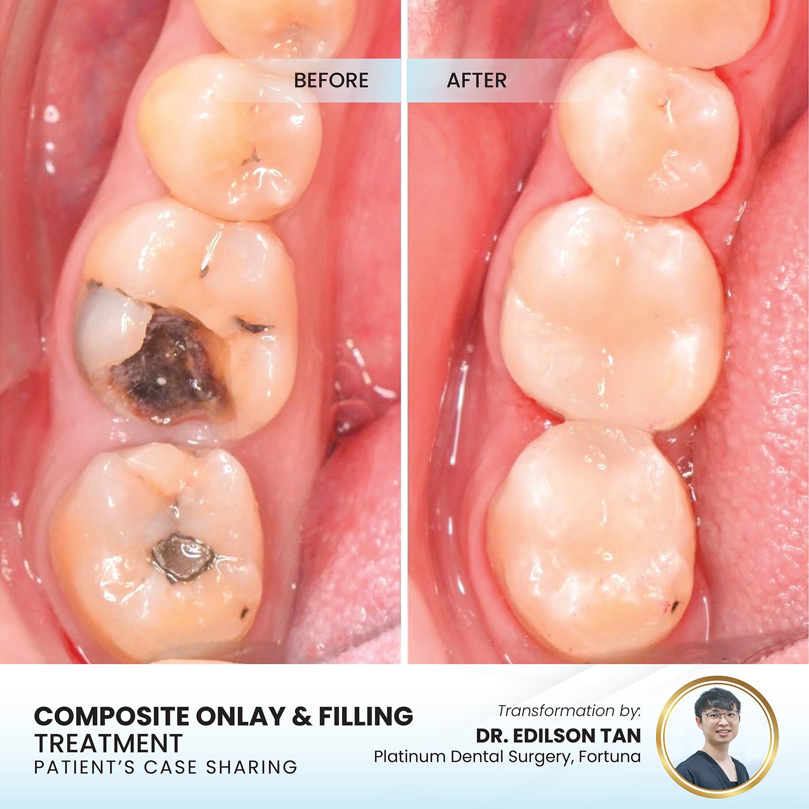 Patient smile transformation - Case I-26