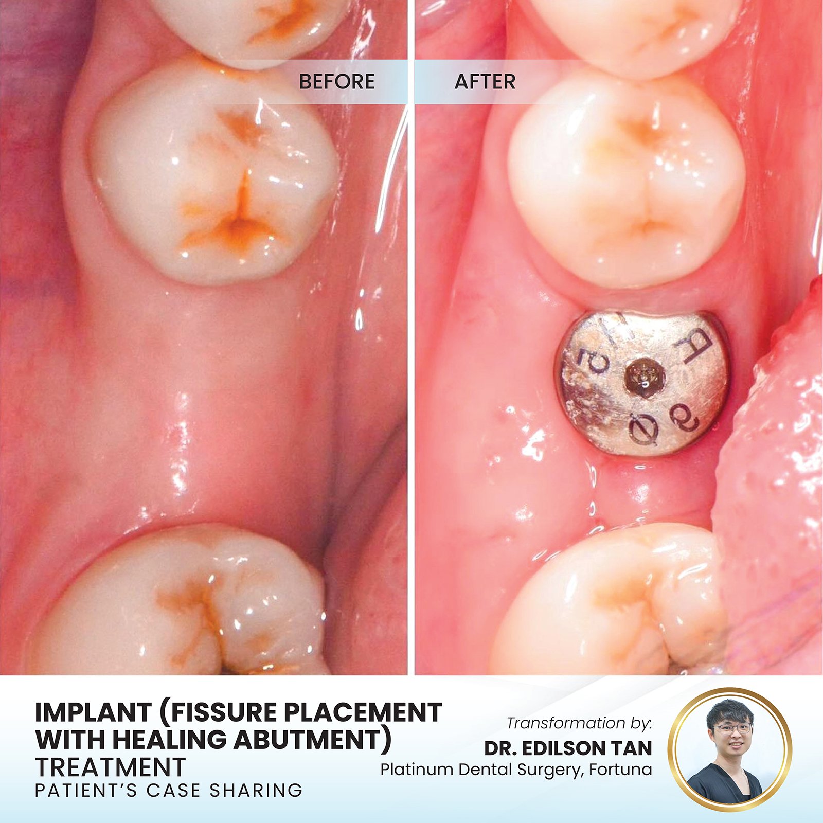 Patient smile transformation - Case I-27