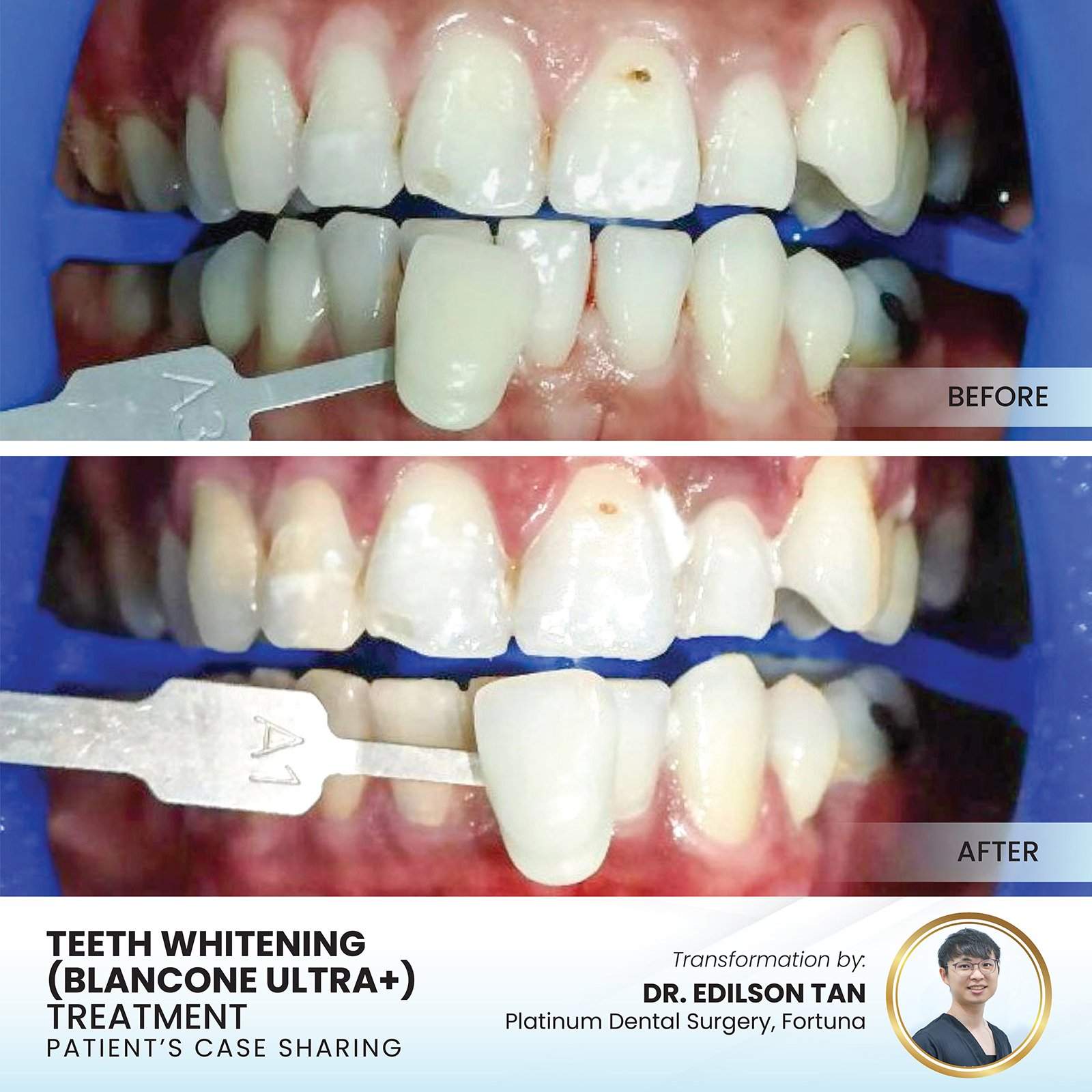 Patient smile transformation - Case I-28
