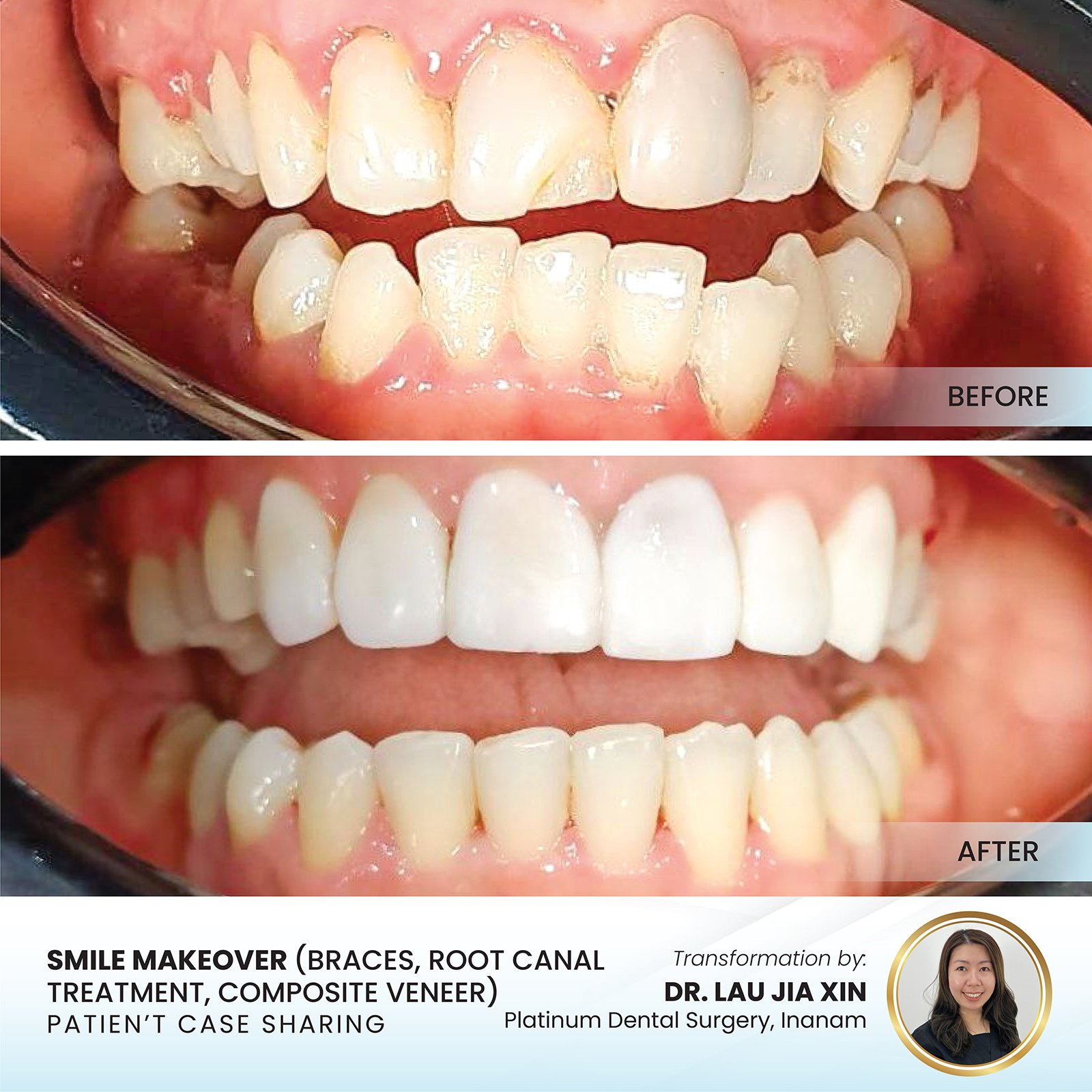 Patient smile transformation - Case I-3