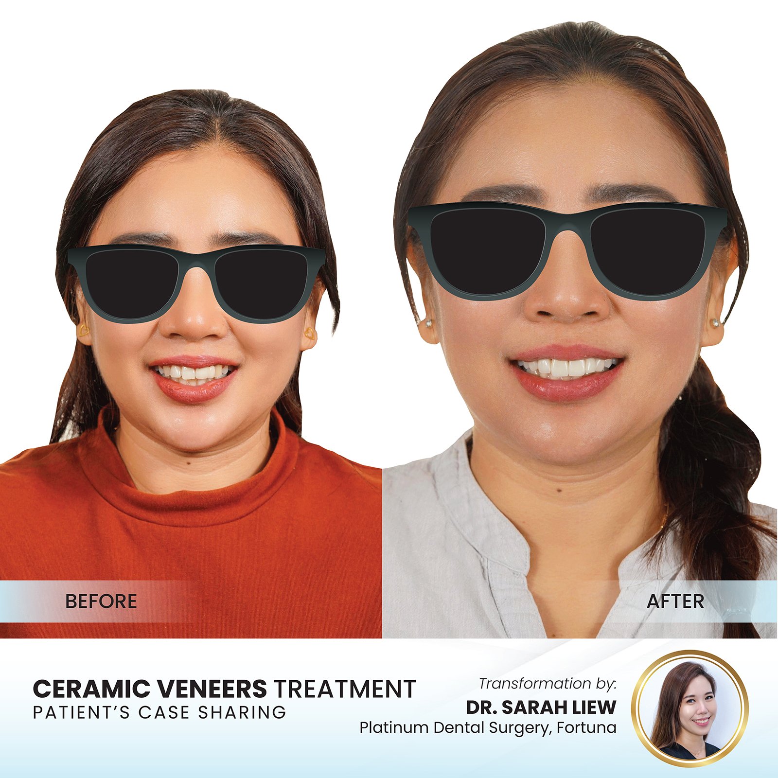 Patient smile transformation - Case I-31