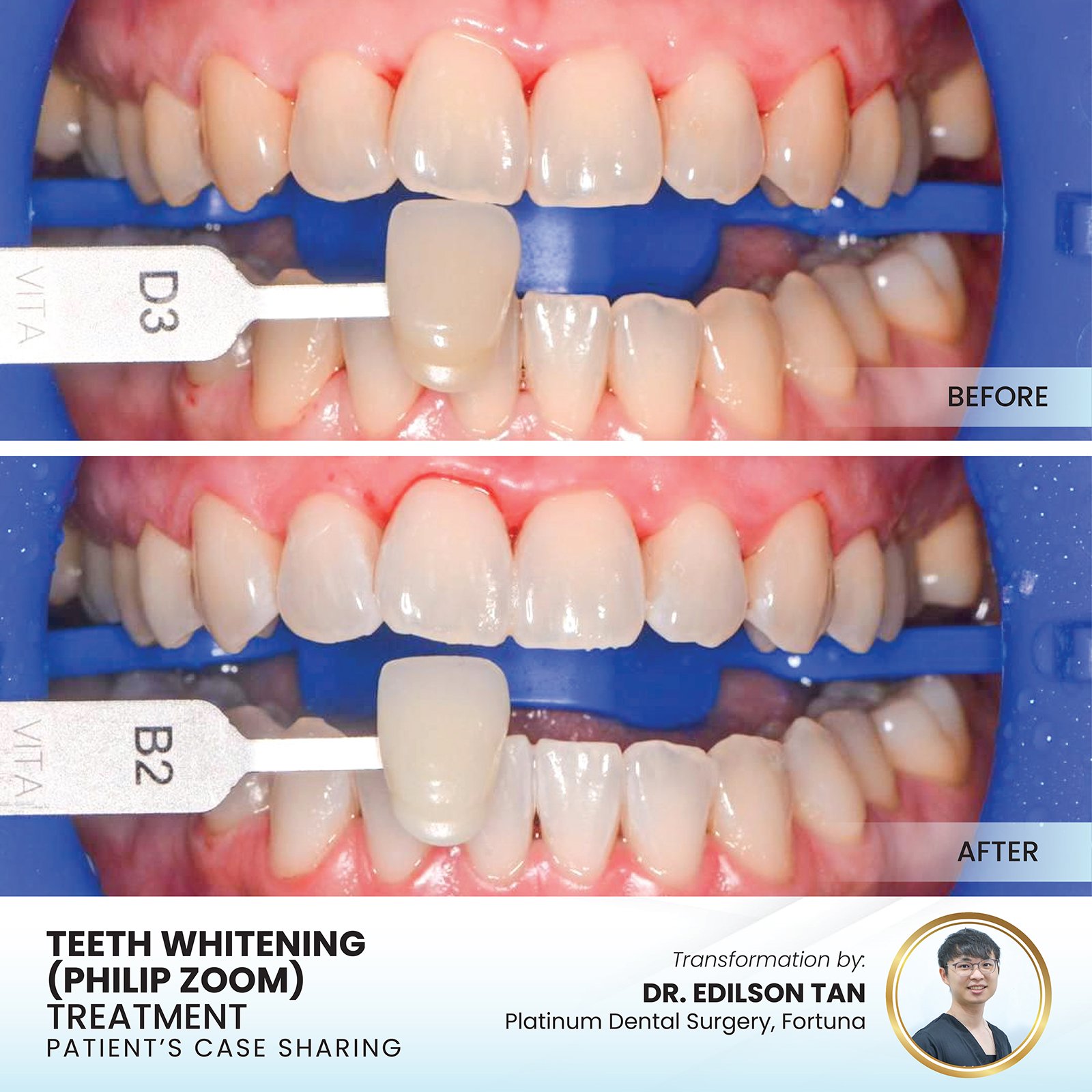 Patient smile transformation - Case I-32