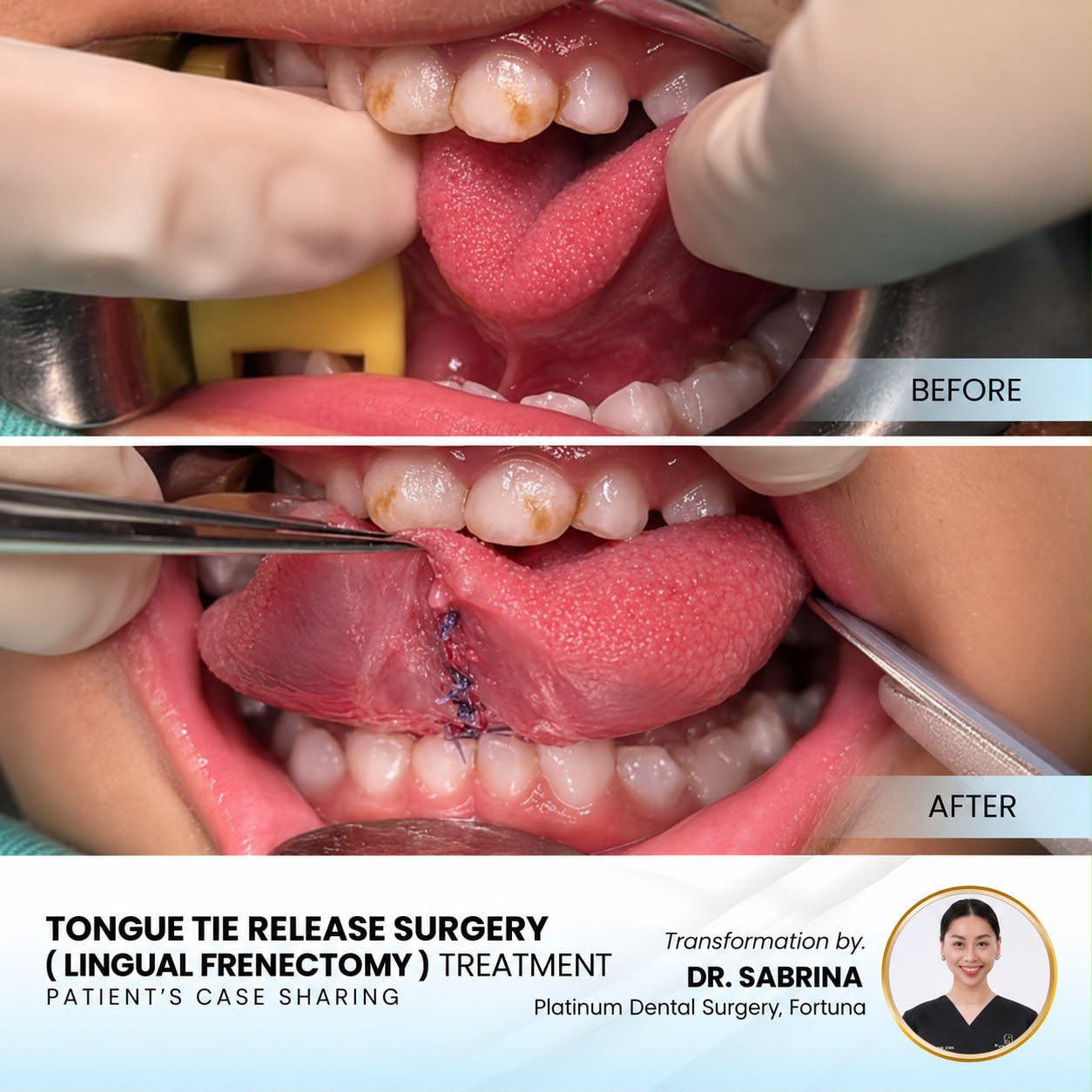 Tongue tie release surgery (lingual frenectomy) case sharing at Platinum Dental Group