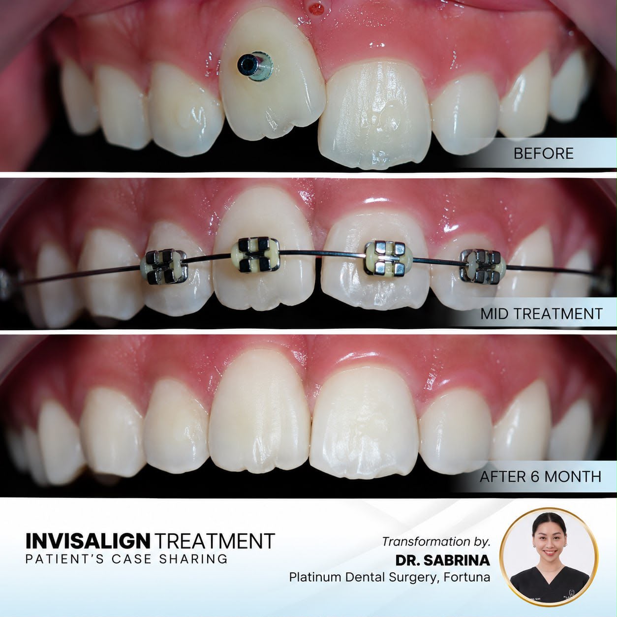 Invisalign treatment case sharing for a child at Platinum Dental Group
