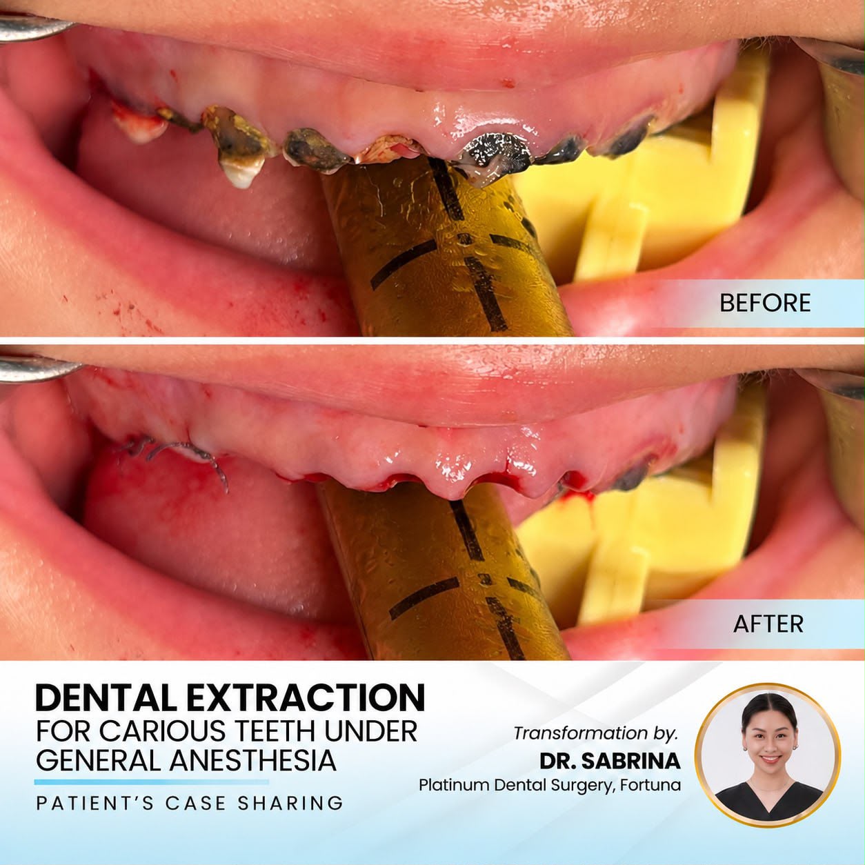Dental extraction for carious teeth under general anaesthesia case sharing