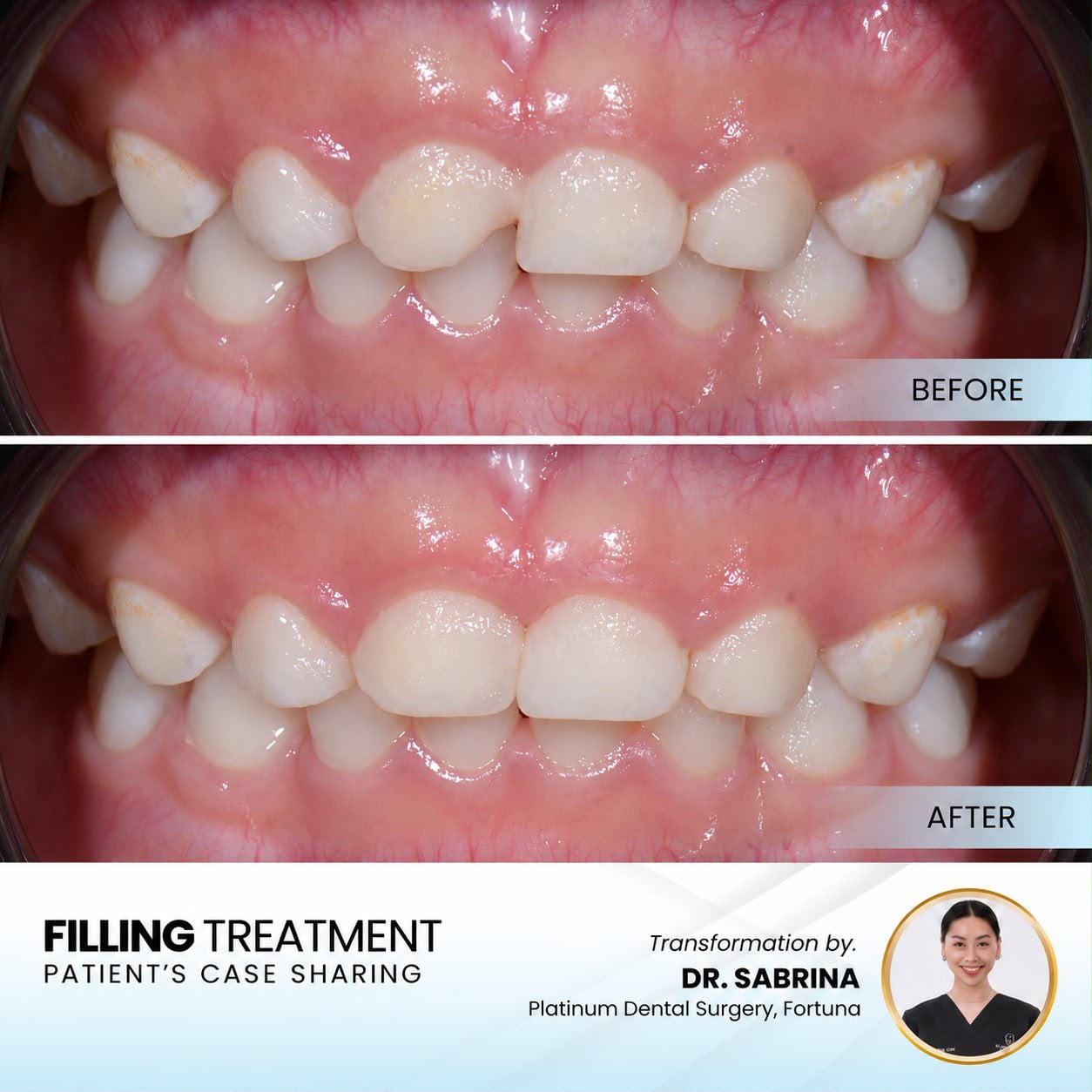 Filling treatment case sharing at Platinum Dental Group