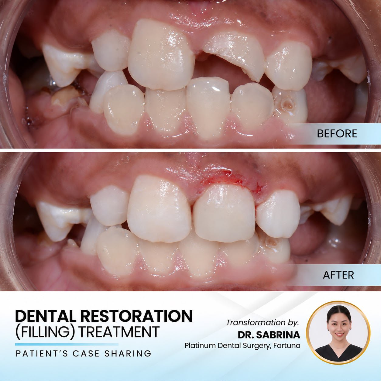 Dental restoration (filling) treatment case sharing at Platinum Dental Group
