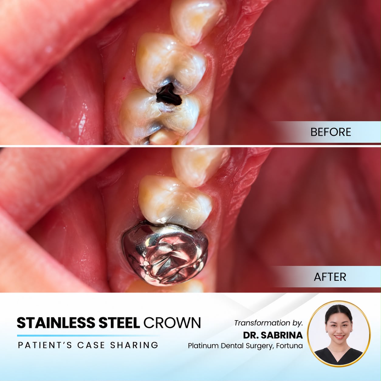 Stainless steel crown case sharing at Platinum Dental Group