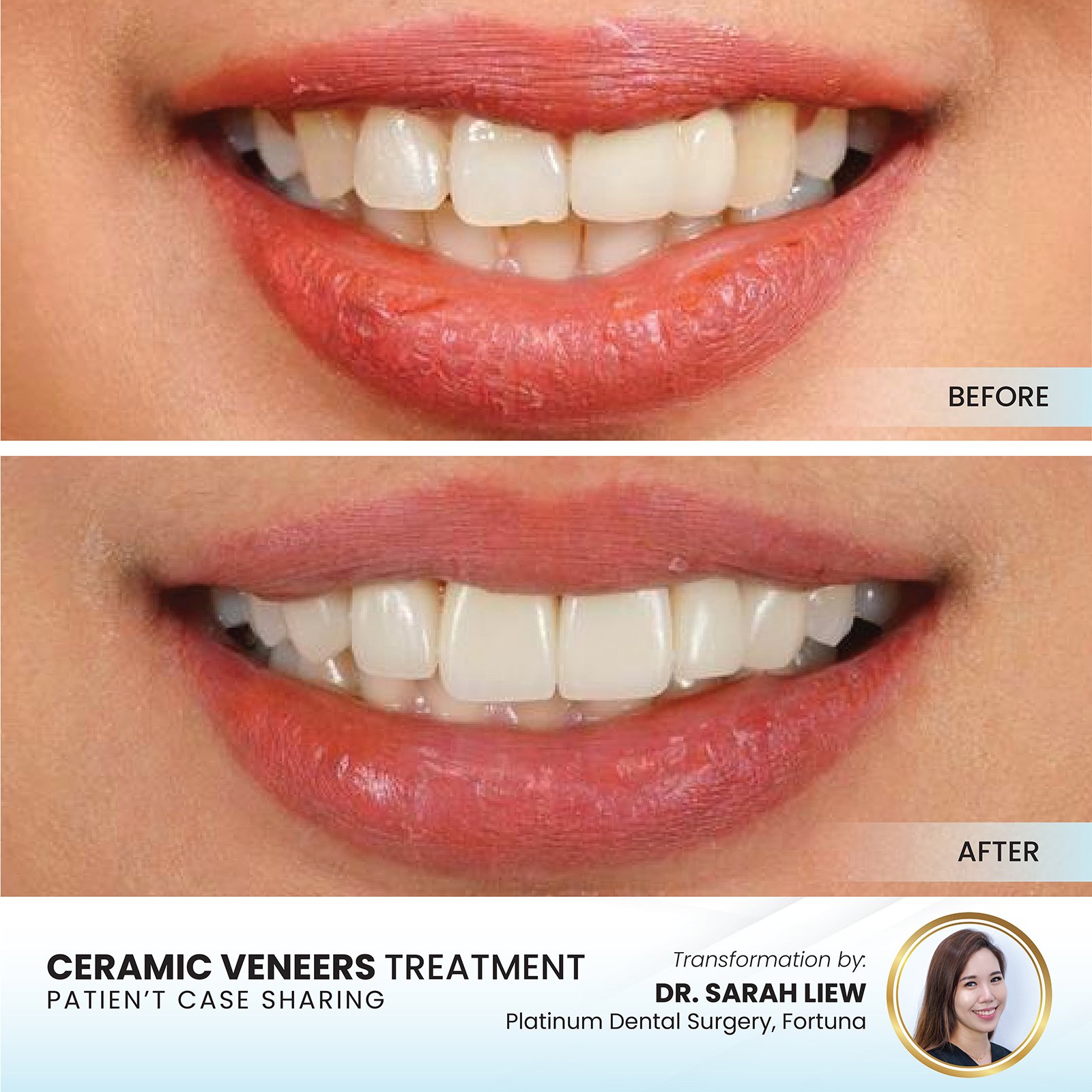 Patient smile transformation - Case I-4