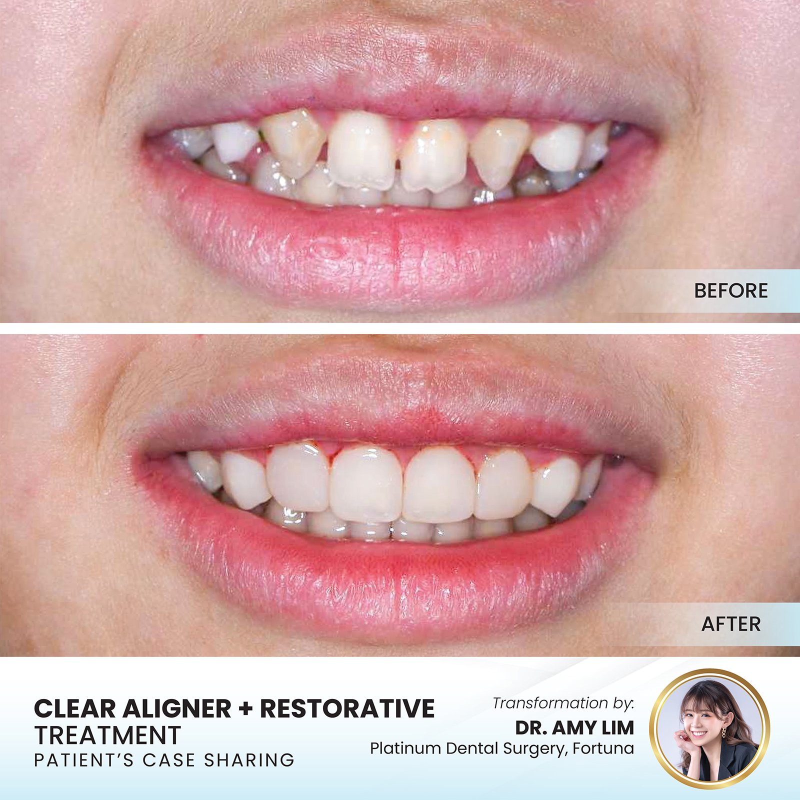Paediatric dental treatment result Platinum Dental