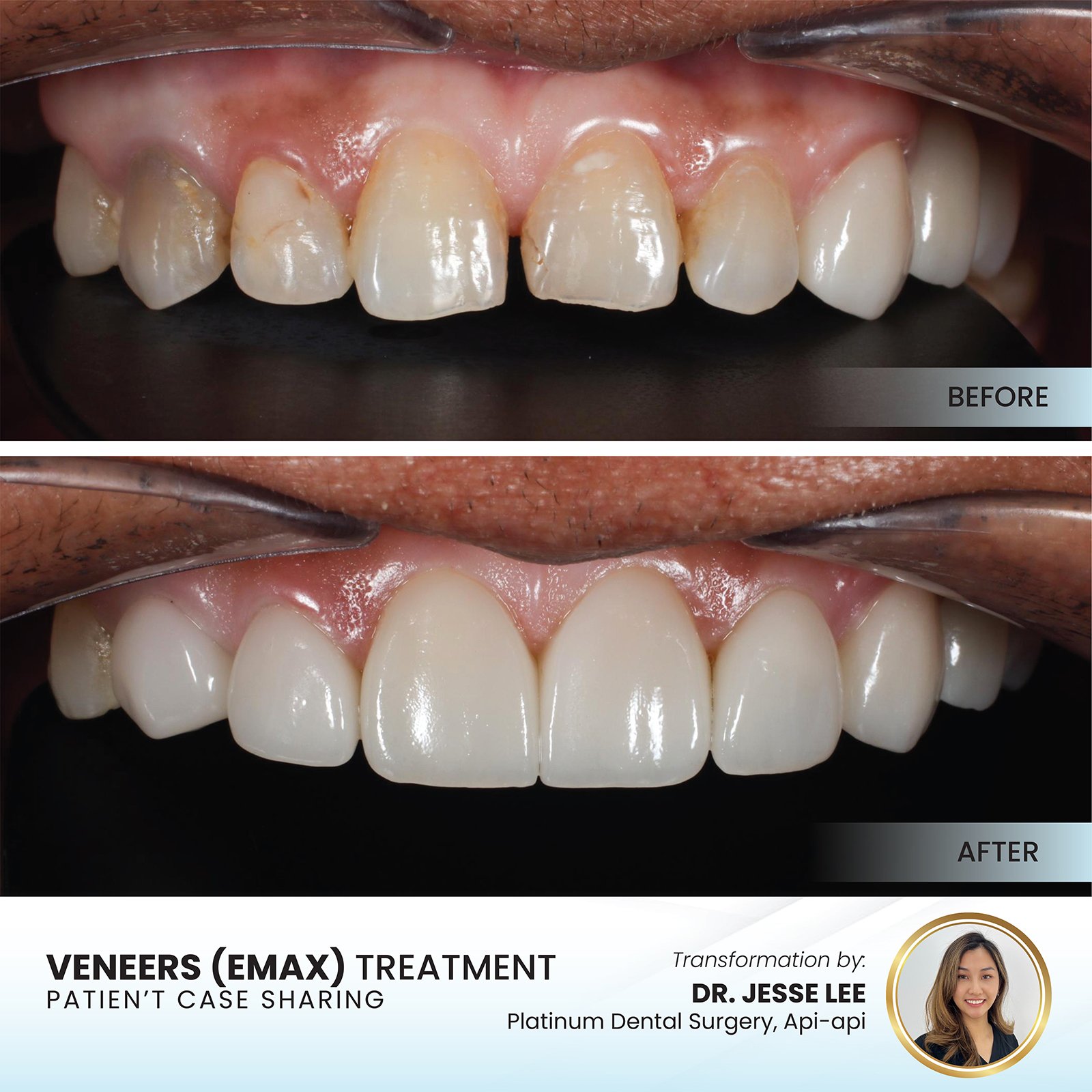 Patient smile transformation - Case I-6