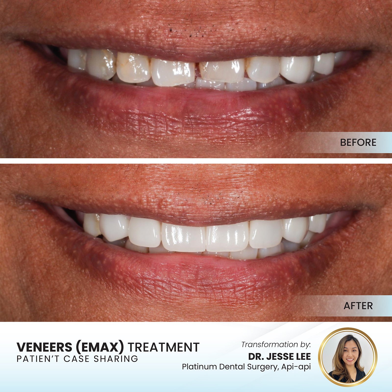 Patient smile transformation - Case I-7