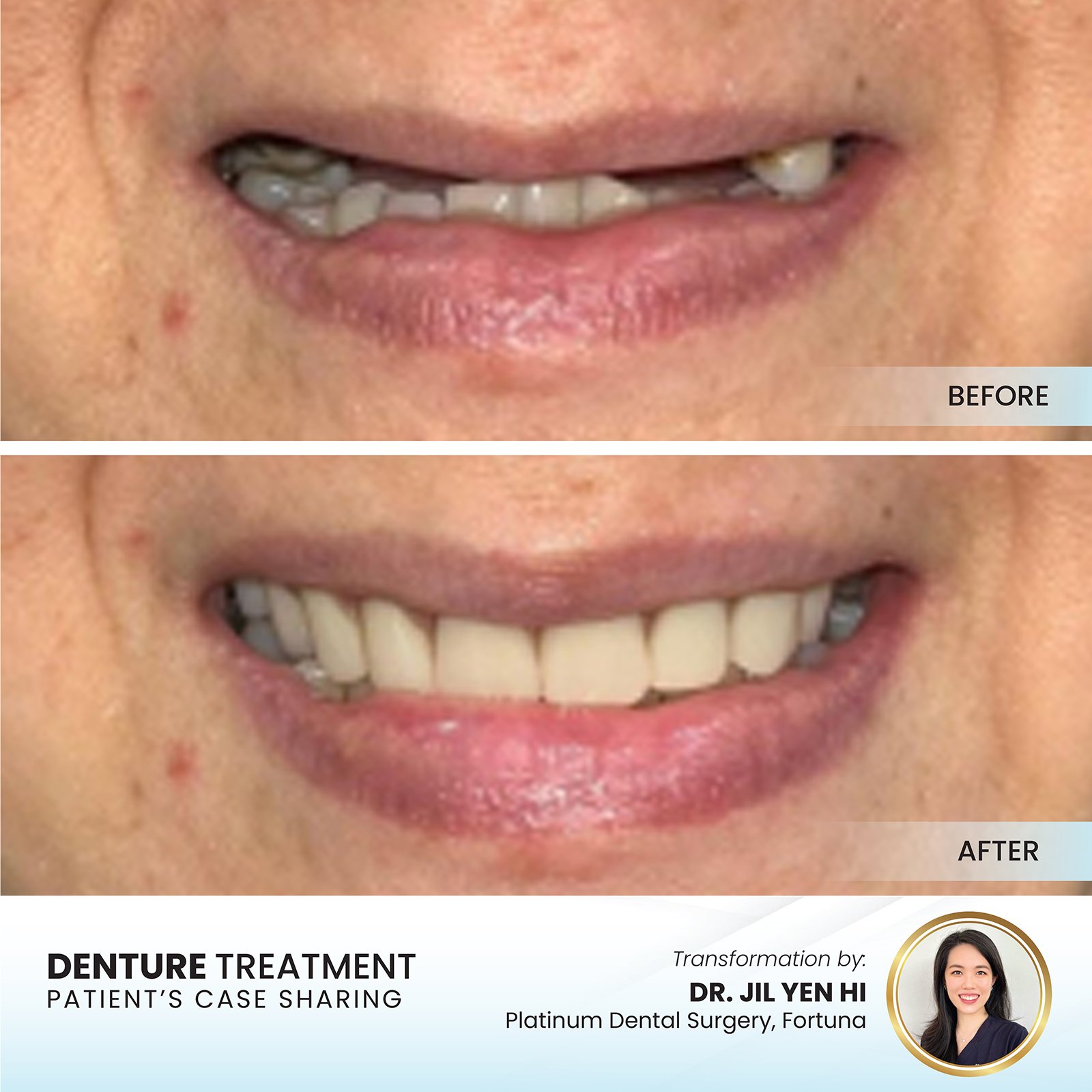 Patient smile transformation - Case II-1