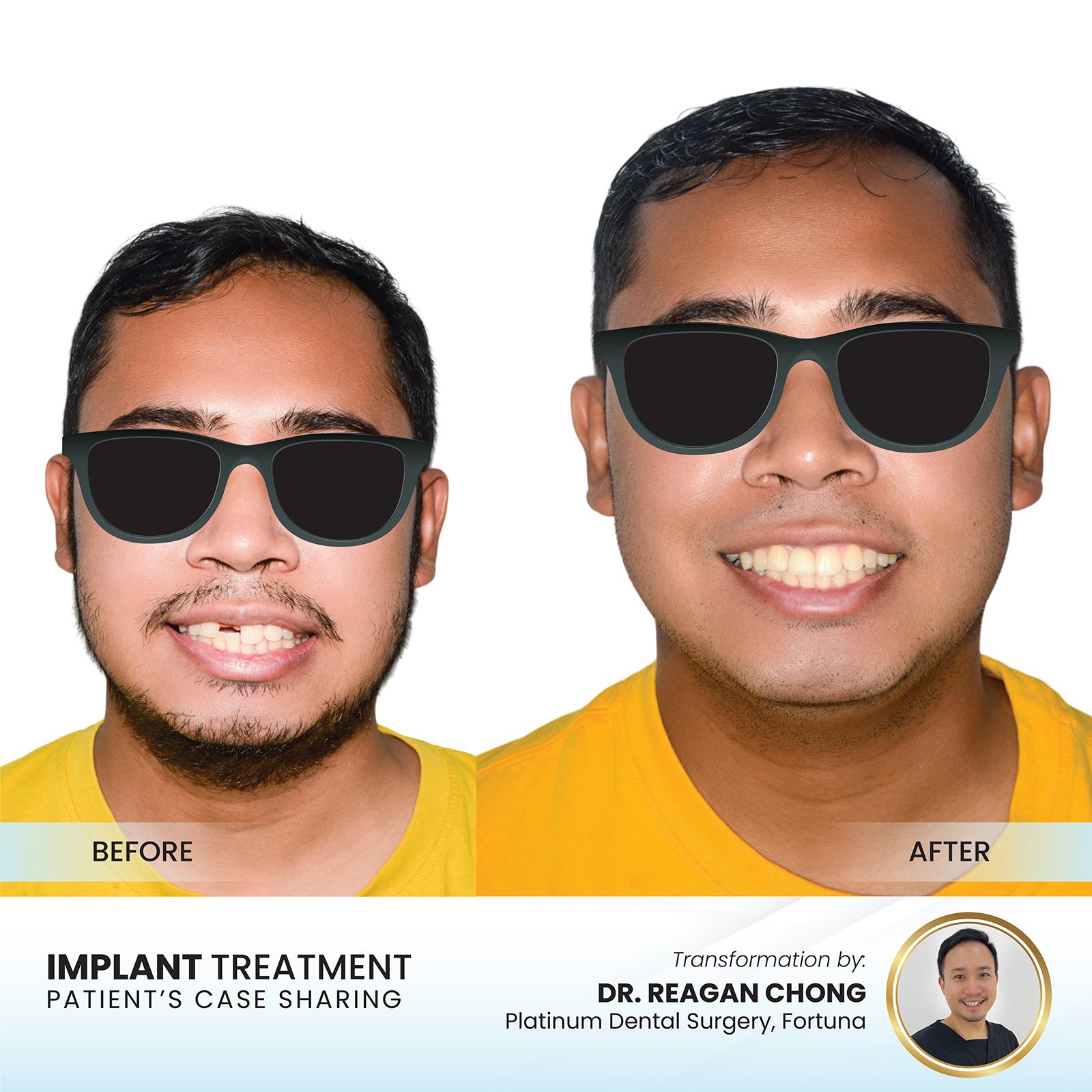 Patient smile transformation - Case II-10