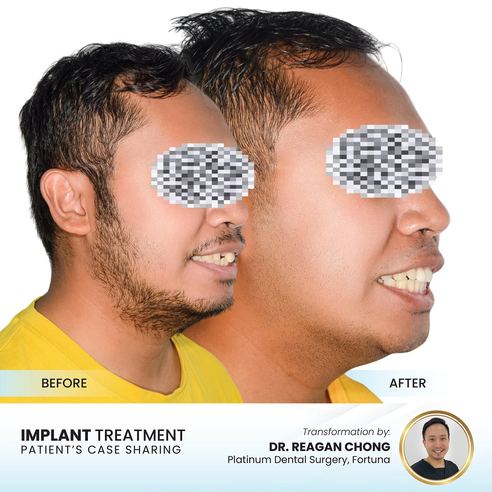 Patient smile transformation - Case II-11