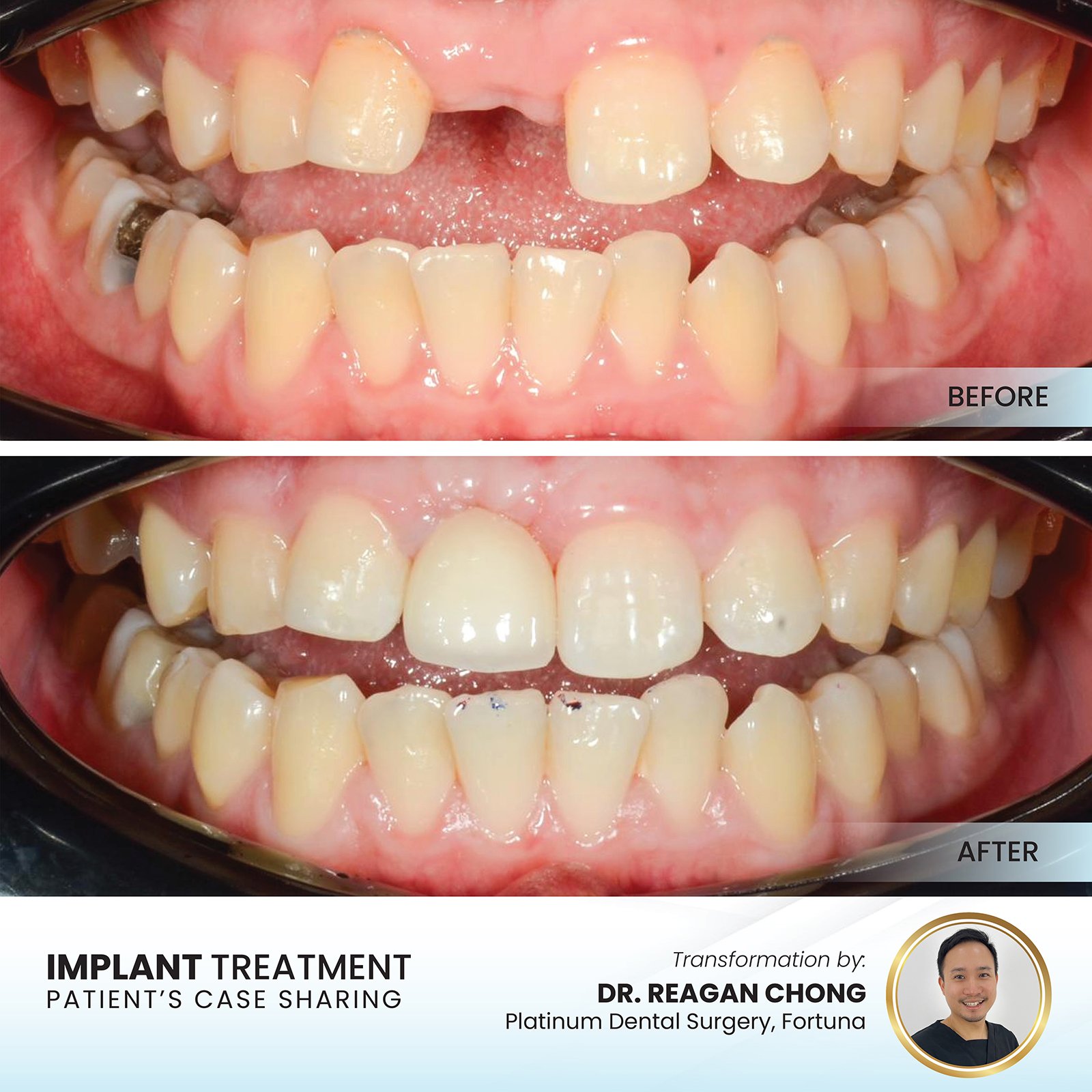 Patient smile transformation - Case II-12