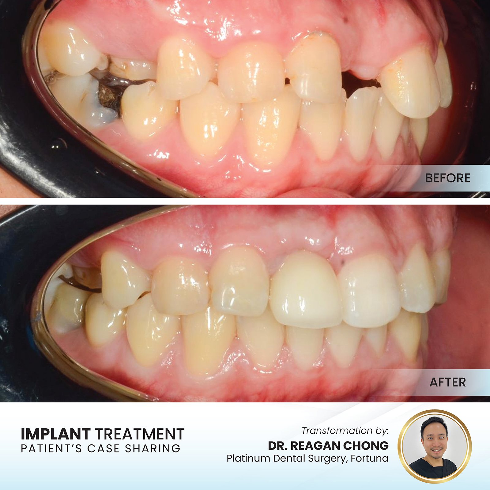 Patient smile transformation - Case II-13