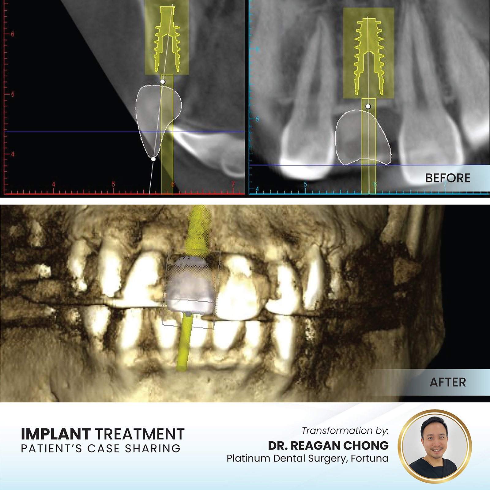 Patient smile transformation - Case II-14