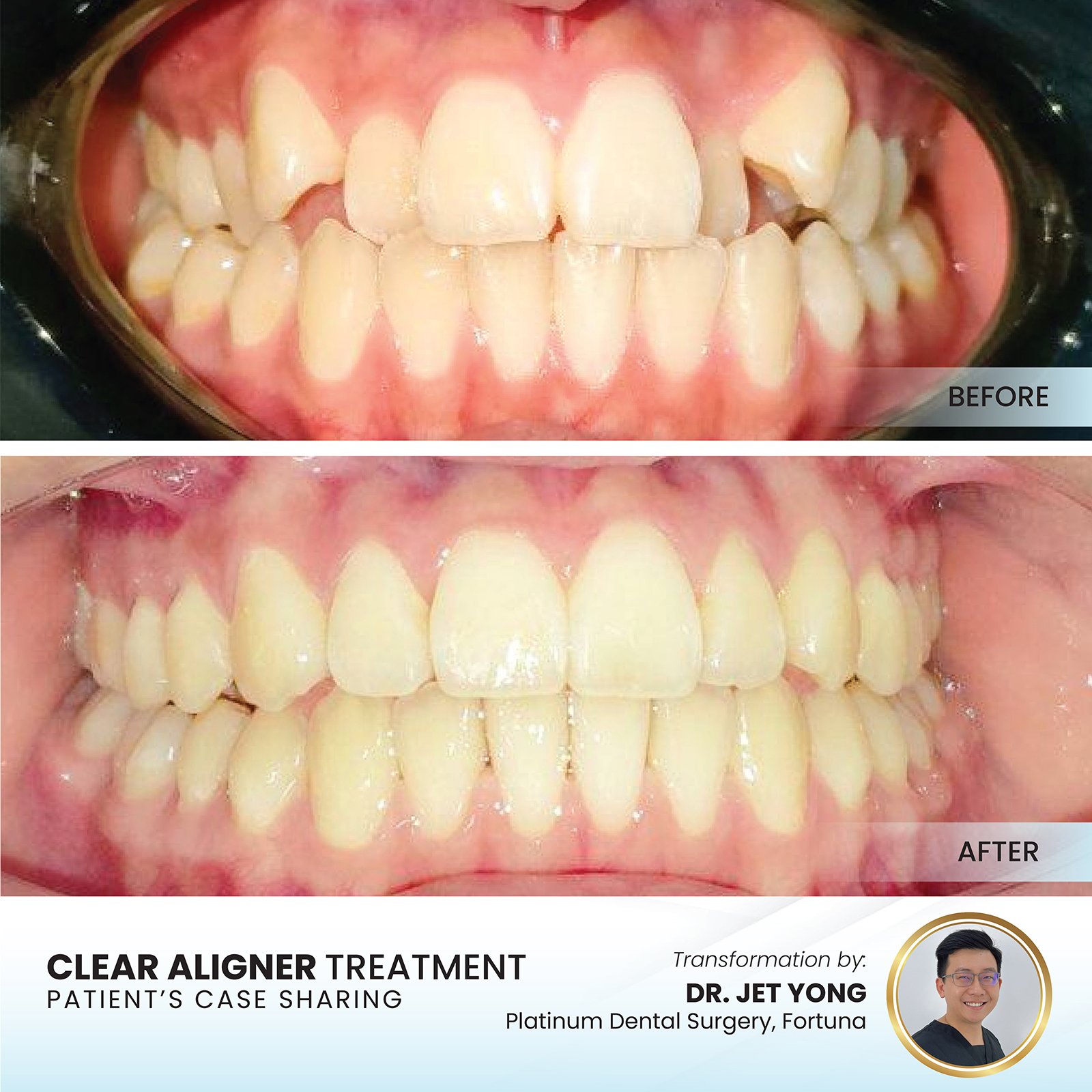 Gaps & Spacing before and after clear aligners