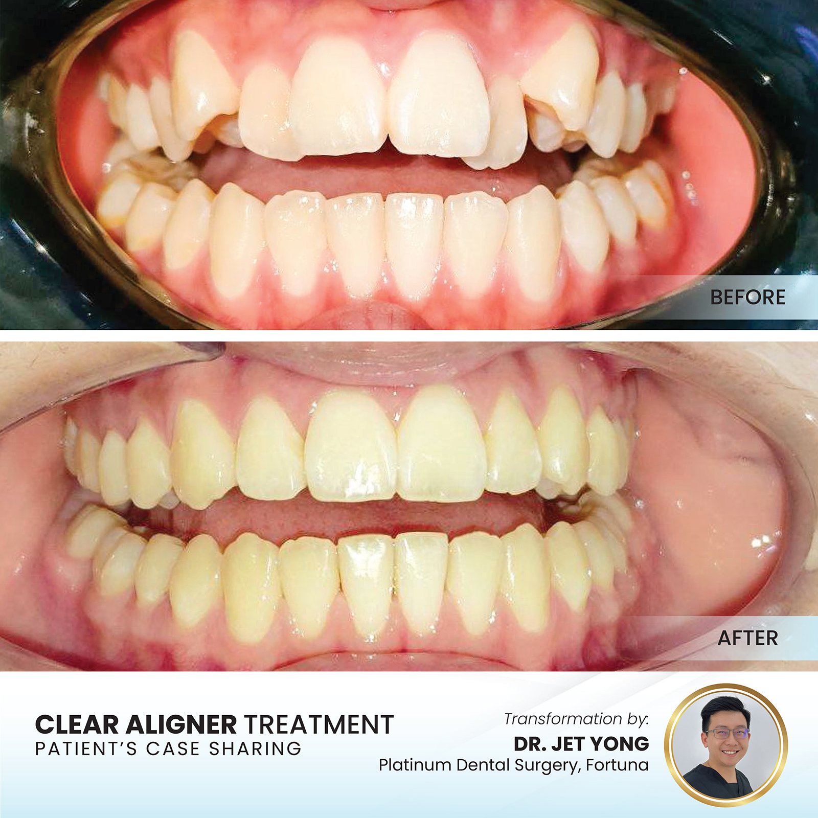 Clear aligner before and after — spacing and rotation corrected, Platinum Dental Group Kota Kinabalu
