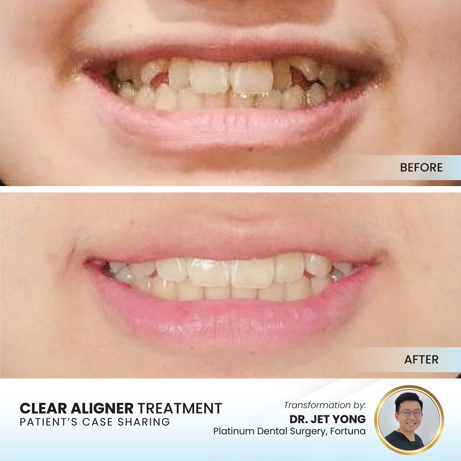Crowded Teeth before and after clear aligners