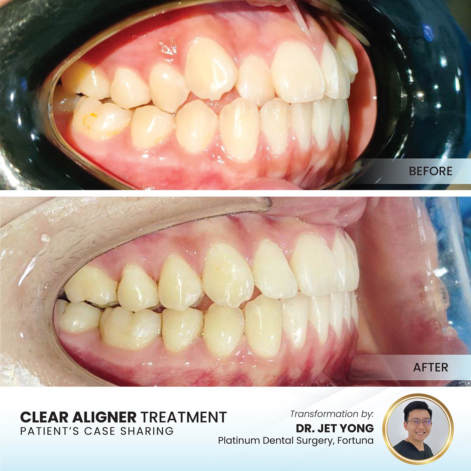 Overbite before and after clear aligners