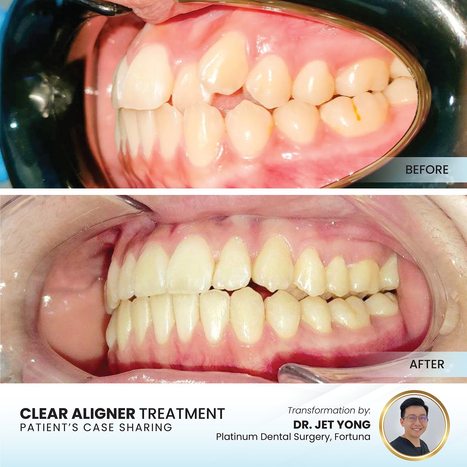 Patient smile transformation - Case II-19