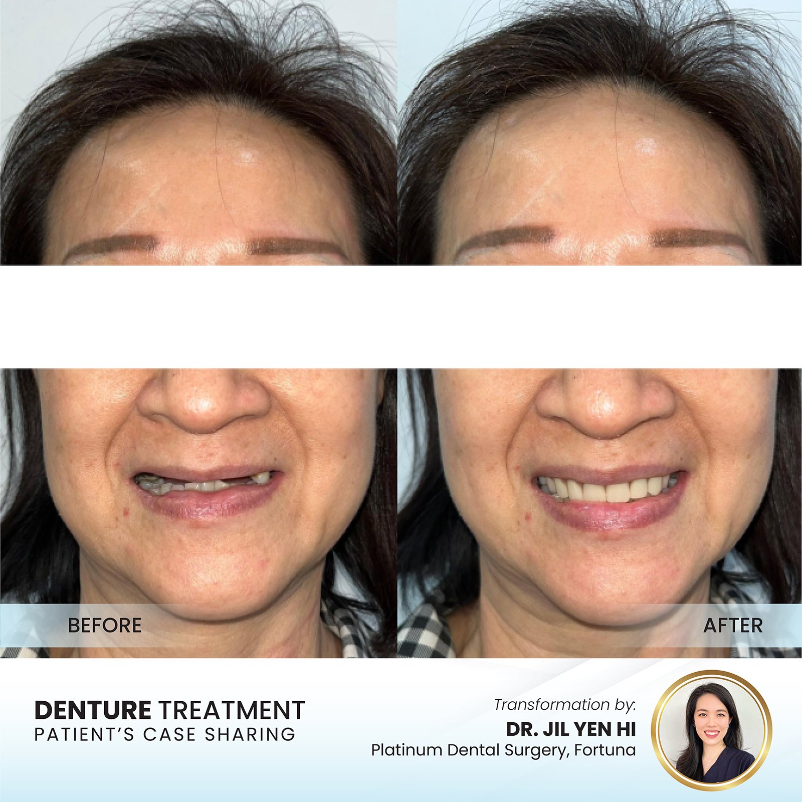 Patient smile transformation - Case II-2