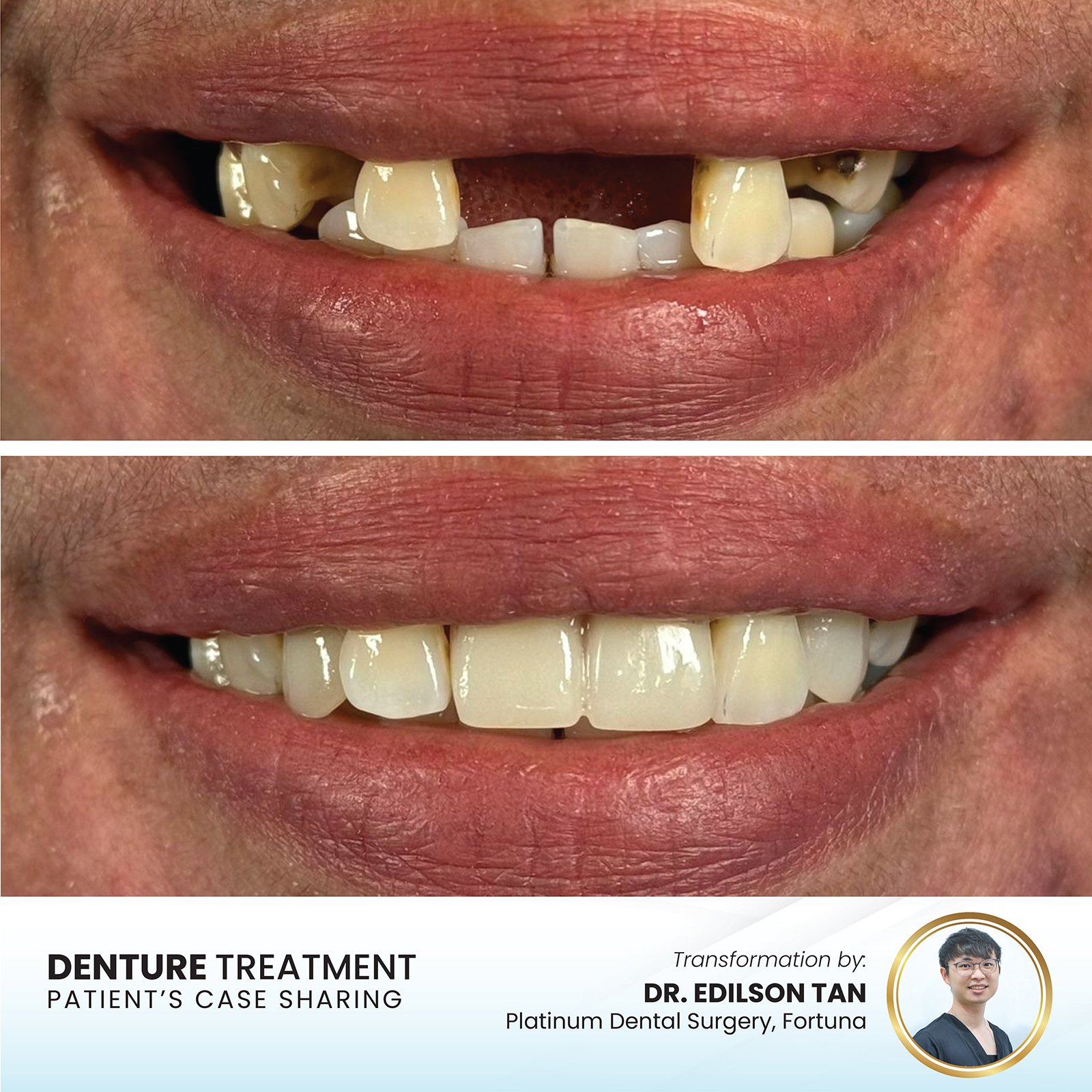 Patient smile transformation - Case II-20
