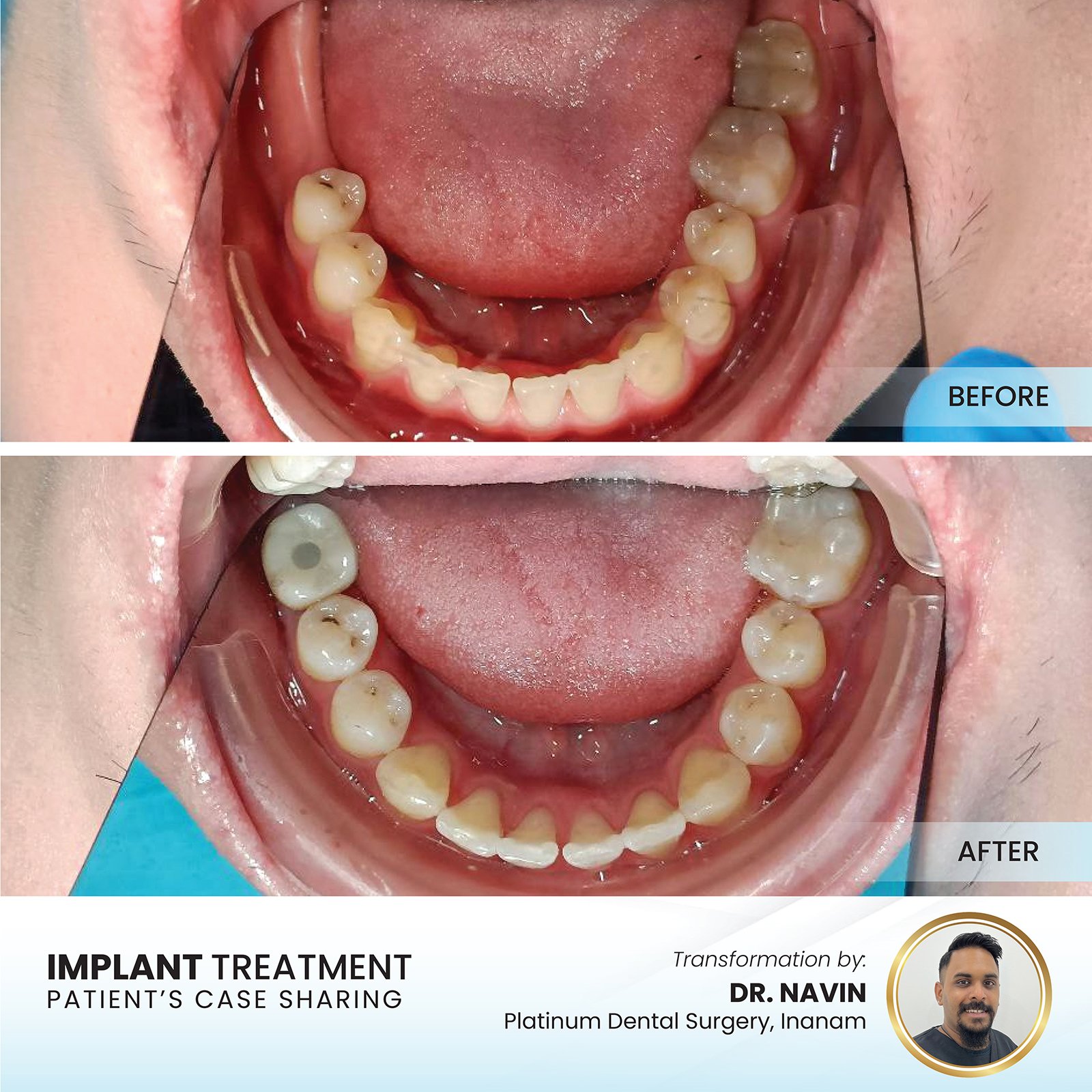 Real dental implant before and after case by Dr Navin at Platinum Dental Group
