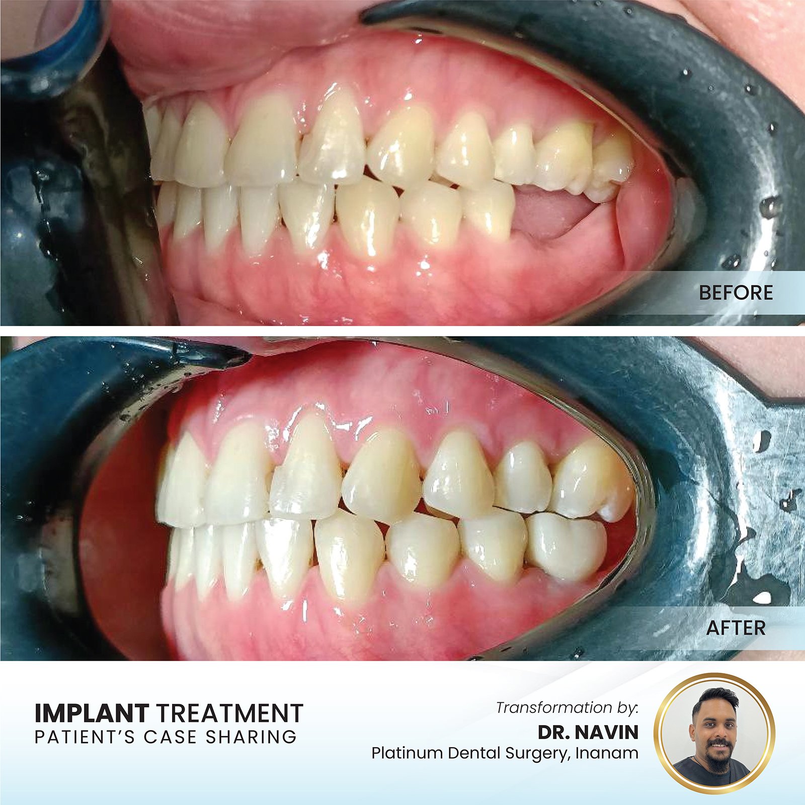 Patient smile transformation - Case II-22