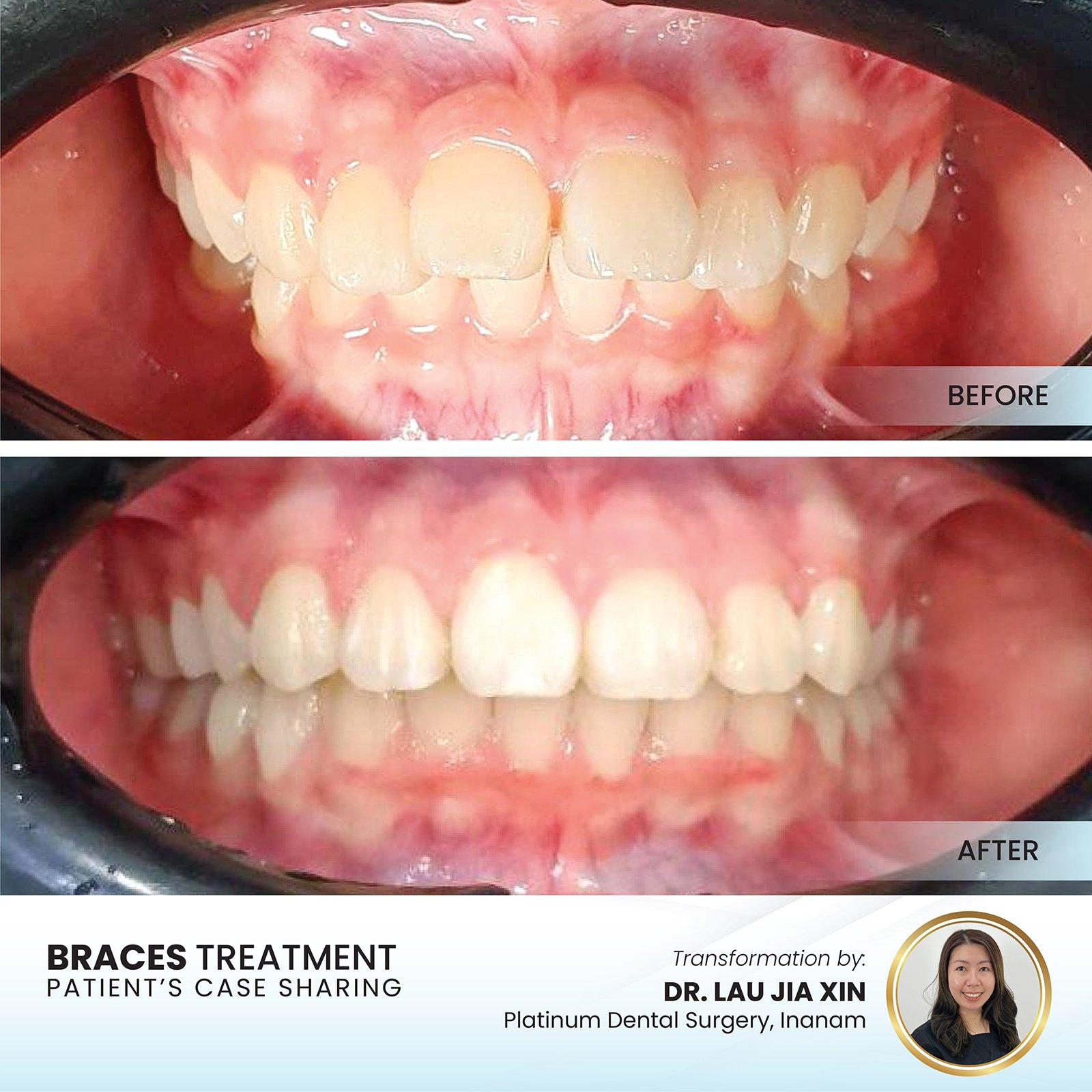 Braces before and after — crowding corrected, Platinum Dental Group Kota Kinabalu