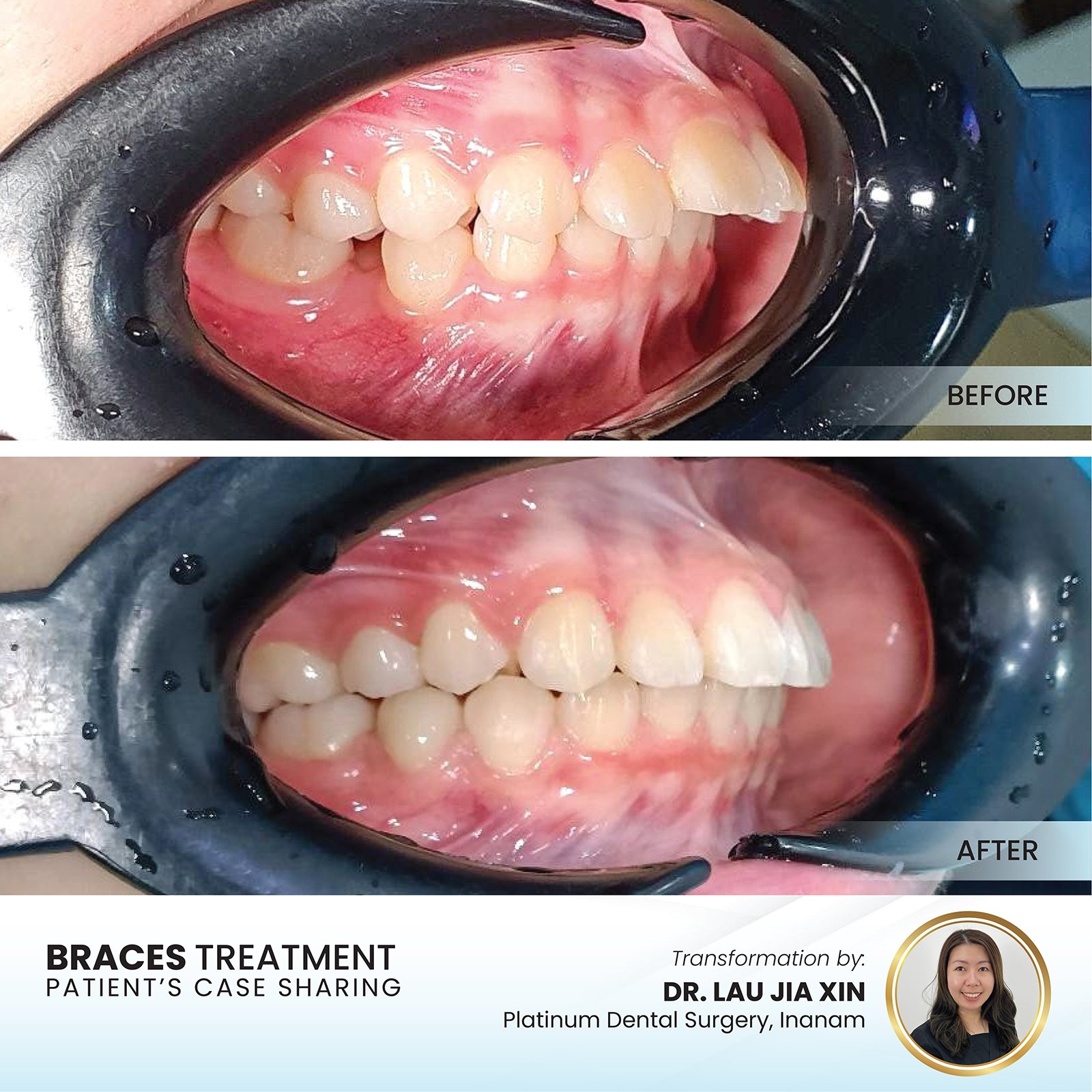 Patient smile transformation - Case II-25